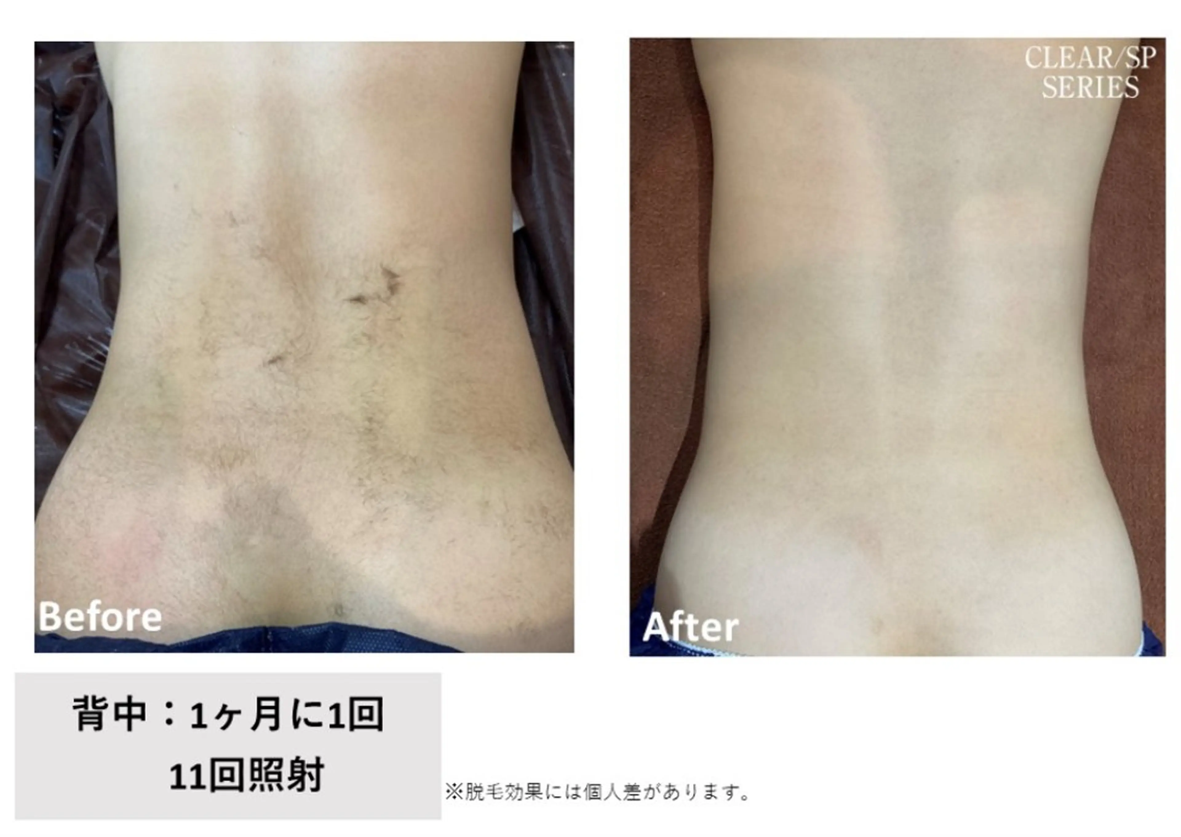 【国内産】NBS美容全身脱毛《お顔・VIO無》（体験から本格へ）の写真