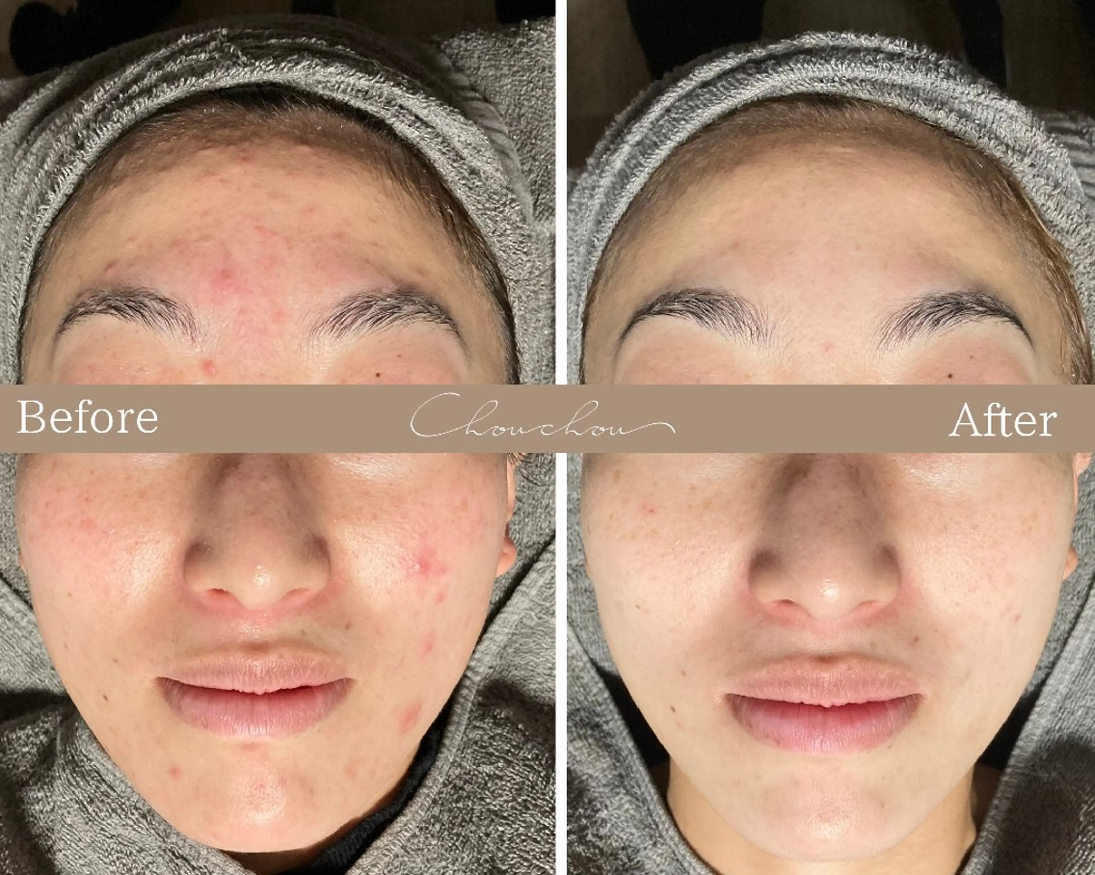 beauty & health salon Chou chou所属・ニキビ・毛穴🌿肌を 育てるララピール✨のエステ・リラクイメージ