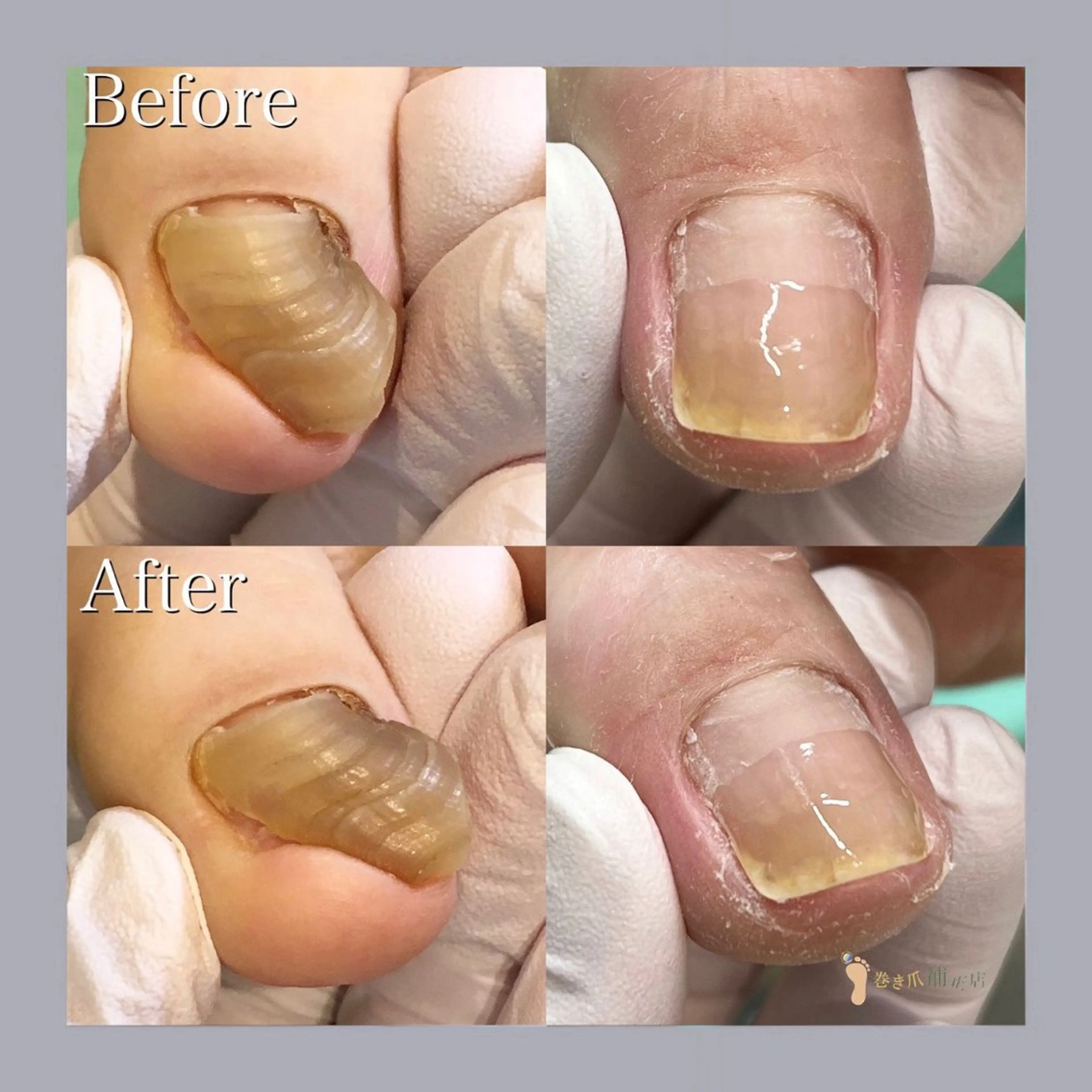 巻き爪補正店 大阪天王寺店のネイルデザイン