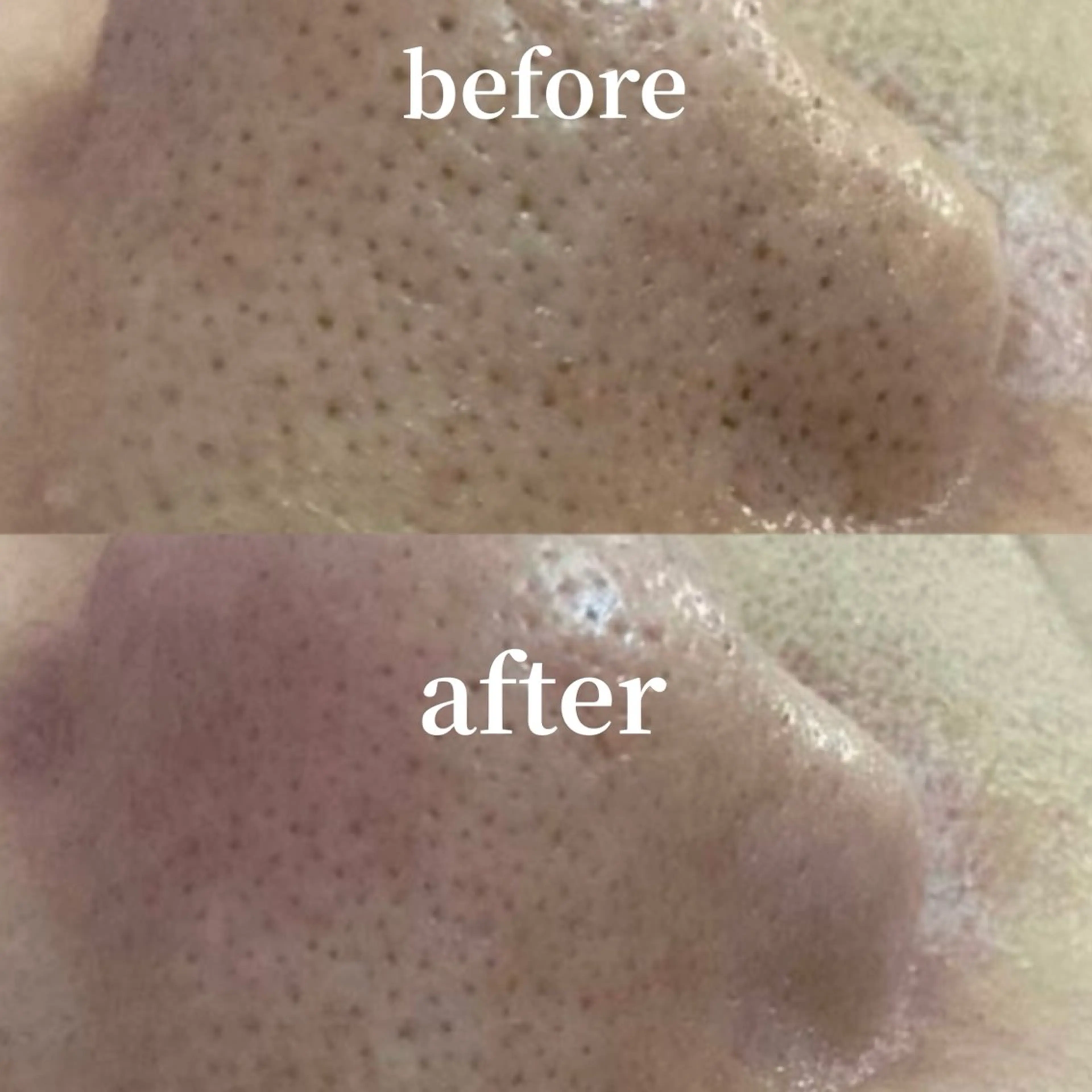 エステ hitohana所属・毛穴/いちご鼻/小顔 /hitohanaのエステ・リラクイメージ