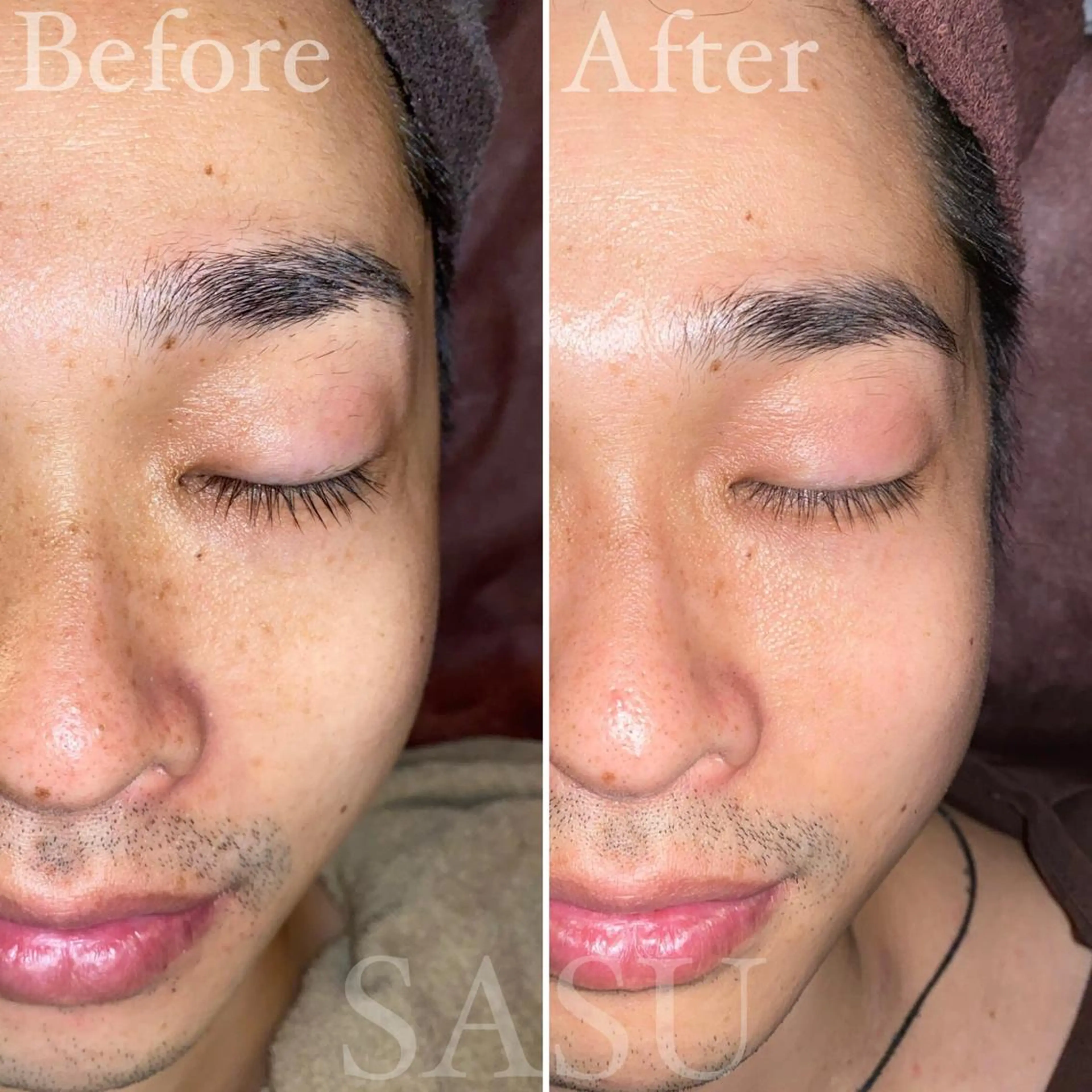 メンズ アイブロウ 即小顔♥️美容鍼× ハーブピーリングのその他イメージ