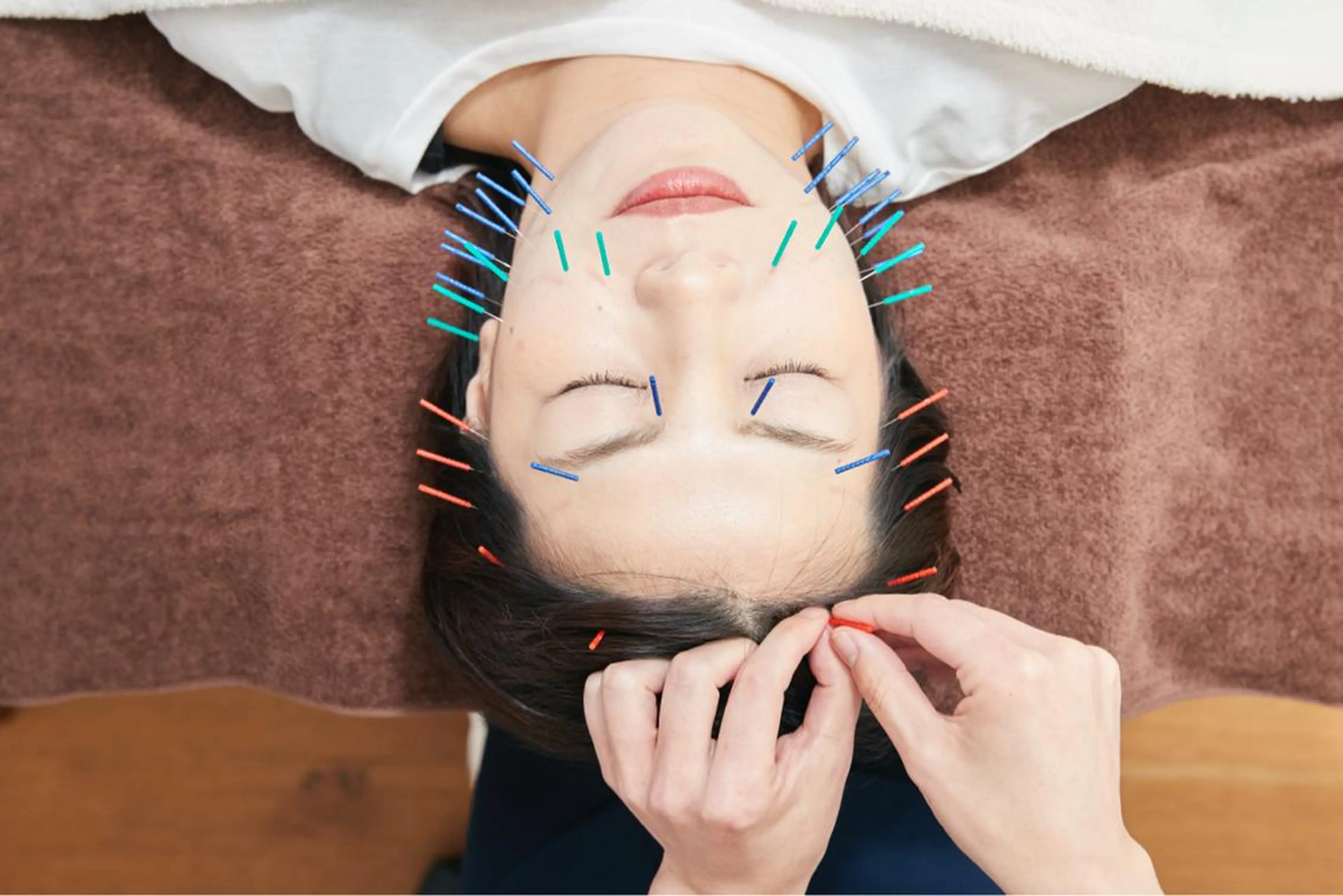 【minimo限定】たるみ集中ケア(小顔、ほうれい線・二重アゴ改善)鍼30本程＋口元パック🪡🫧の写真