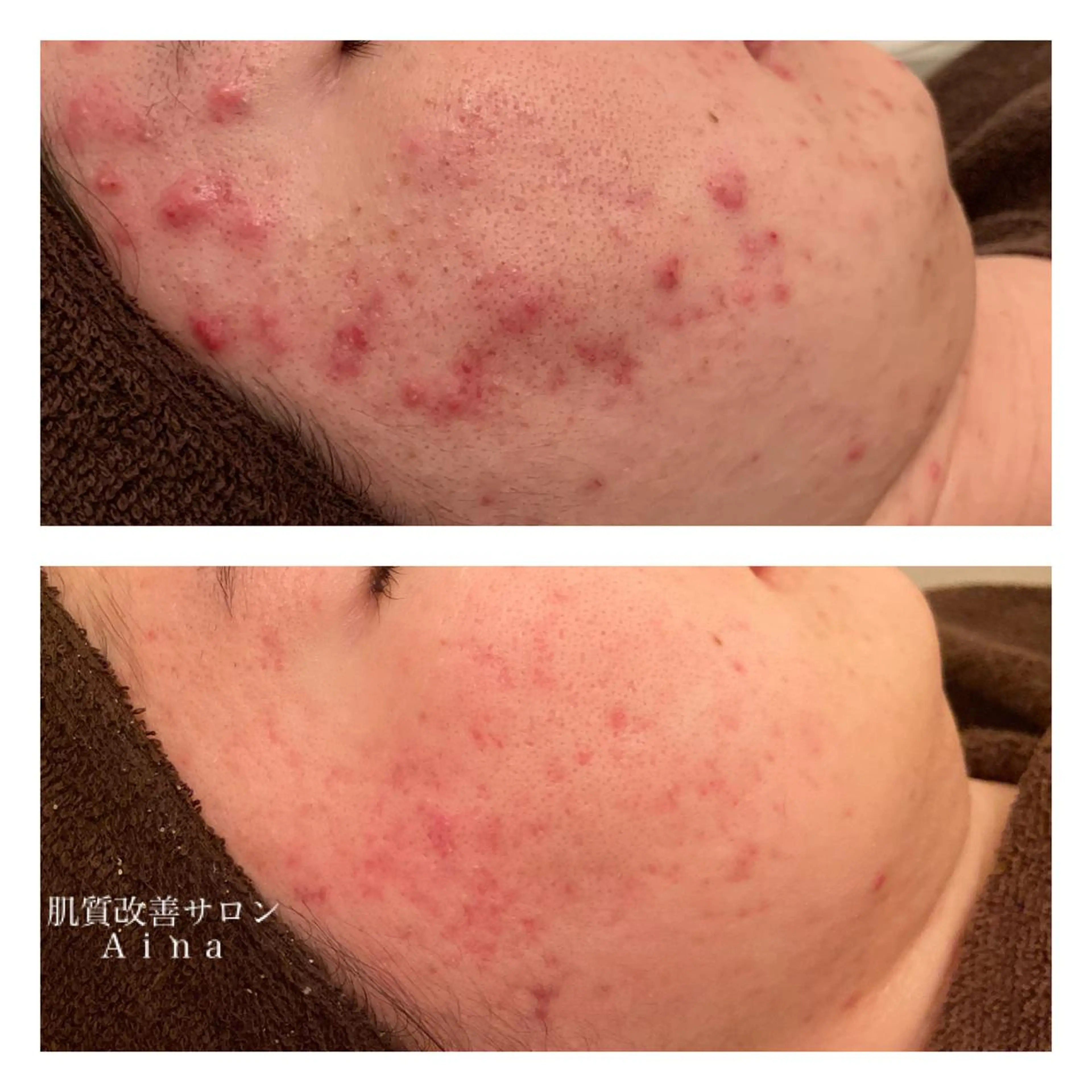 ミディアム カラー パーマ ヘアアレンジ メンズ キッズ ネイル マツエク・マツパ ニキビ跡専門サロン Ainaのエステ・リラクイメージ