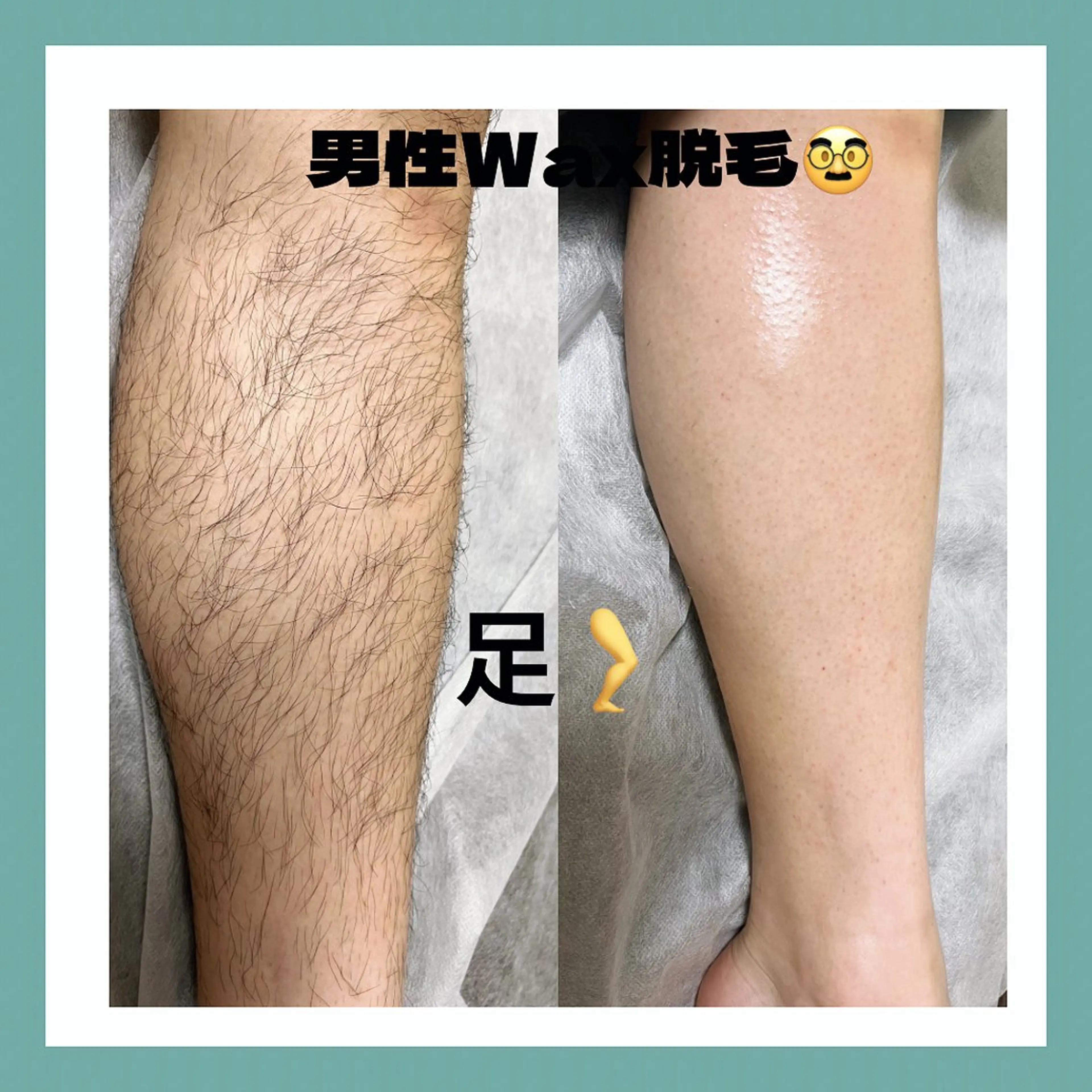 半ズボンも快適メンズ足脱毛🌿ワックス脱毛の写真