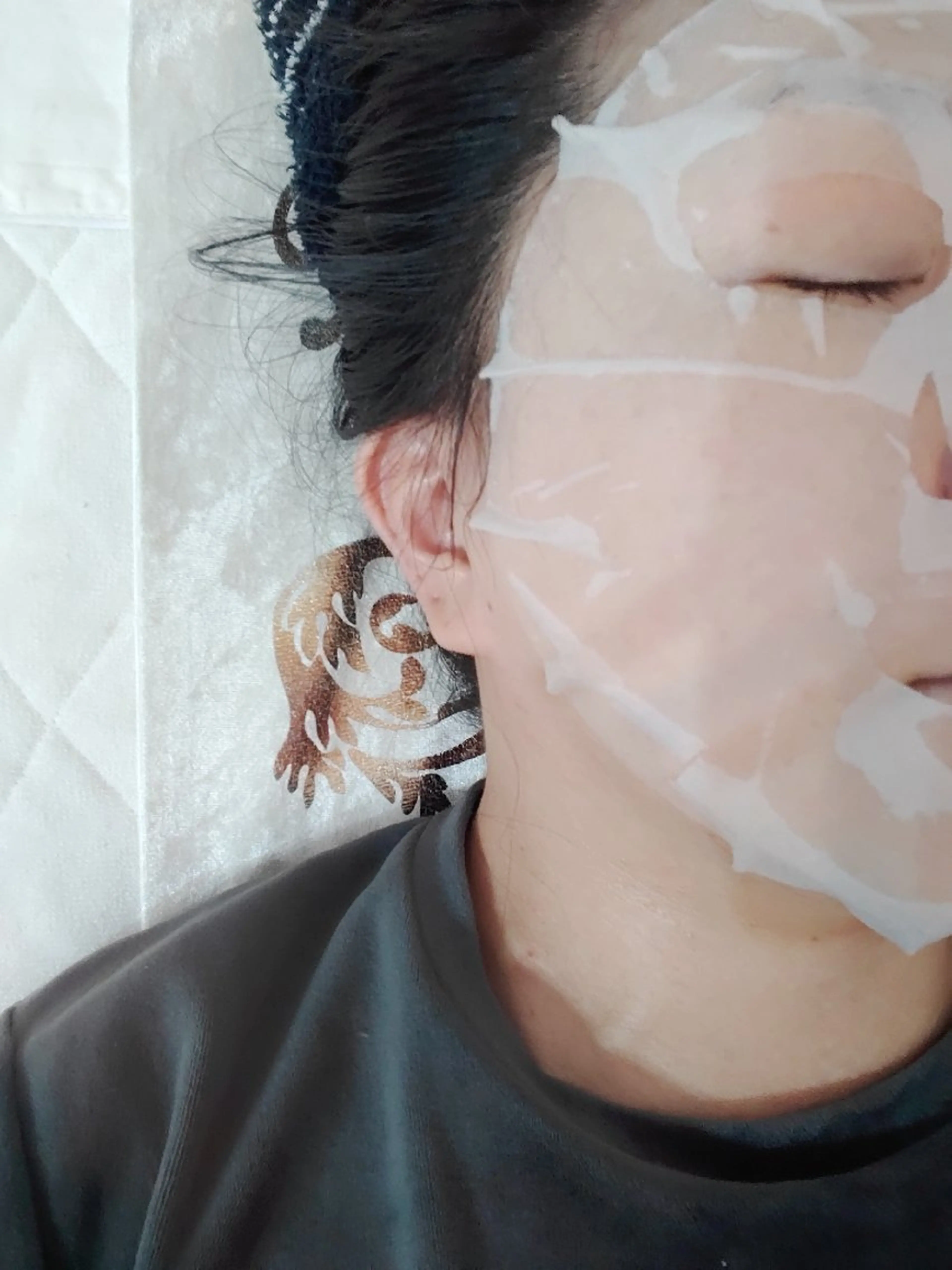 【ダウンタイム専用施術】ボディも可能ご相談下さいの写真