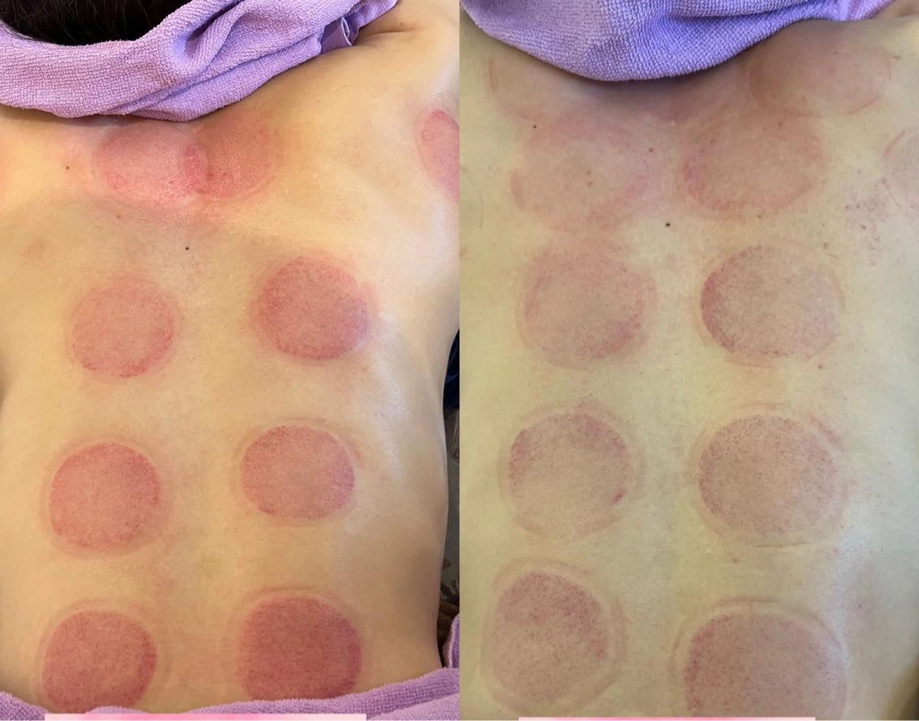 高濃度酸素打ち込みandマジックポットでデトックスカッピングの写真