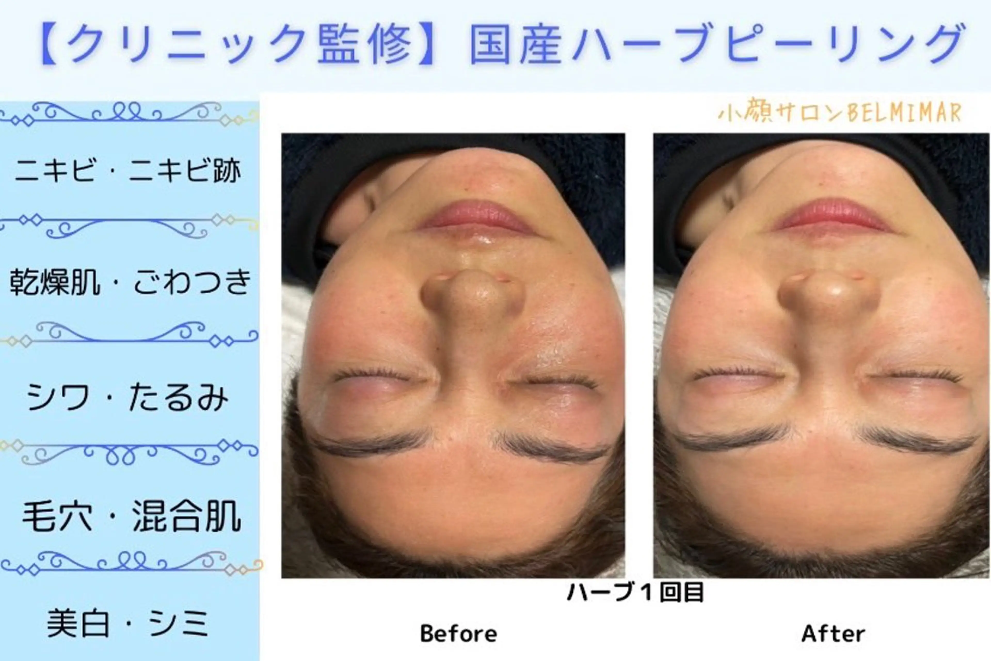 南森町・肌質改善 BELMIMARのエステ・リラクイメージ