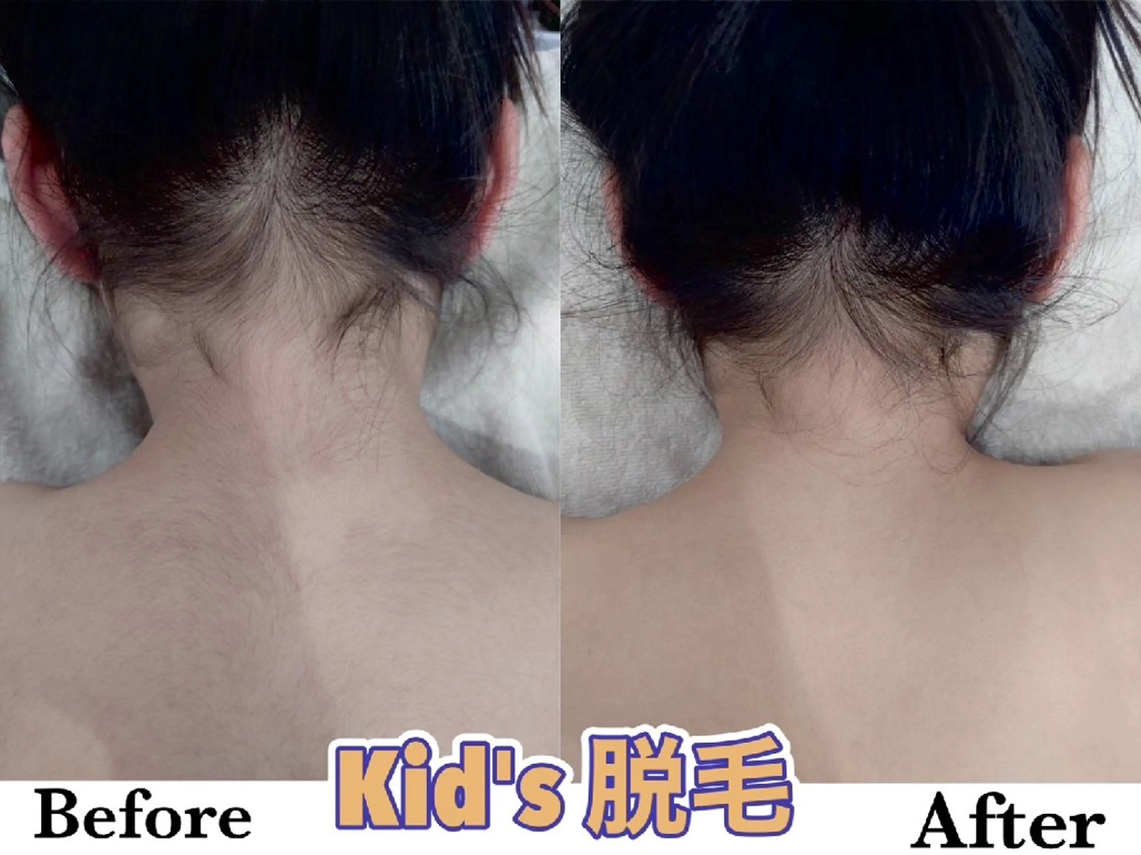 キッズ 脱毛 脱毛＆水素 Salon Lovele所属・脱毛＆水素Salon Loveleのエステ・リラクイメージ