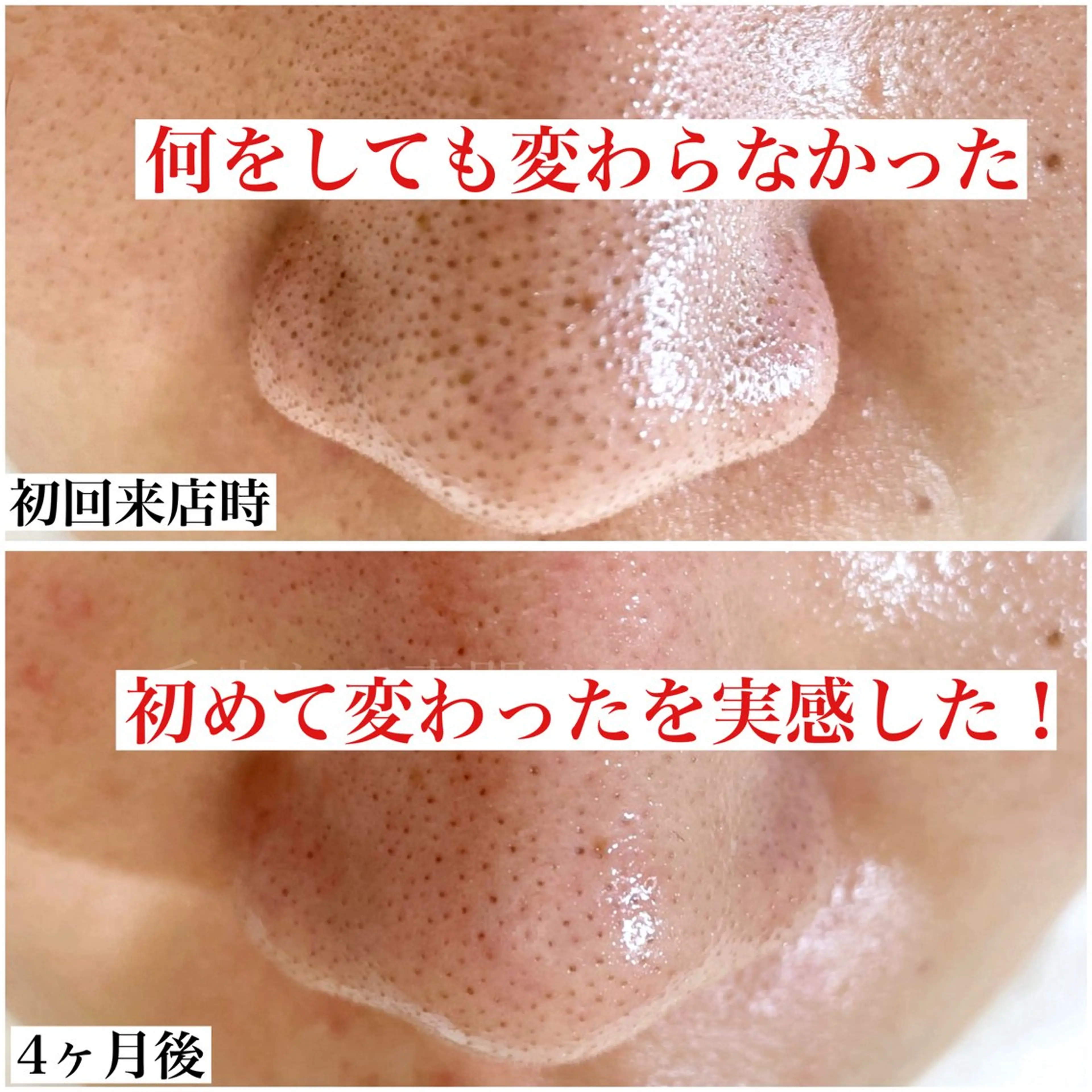 毛穴ケア基礎コース60分　（頑固な角栓、ざらざらのざらつき肌、ベトベトテカリ肌）の写真