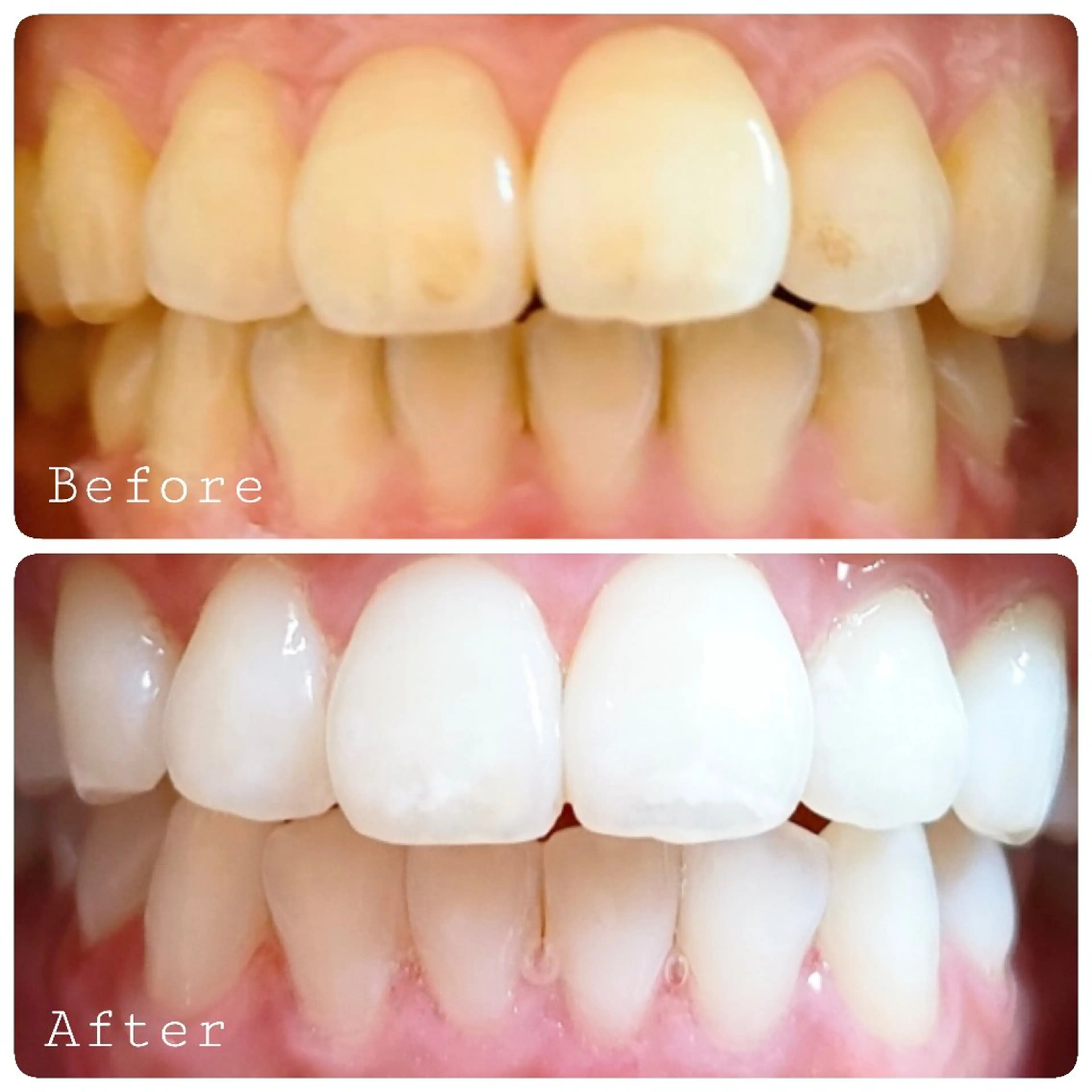 一番人気！セルフホワイトニング30分照射🦷着色汚れ、葉の黄ばみ、ワイン、タバコのご習慣のある方の写真