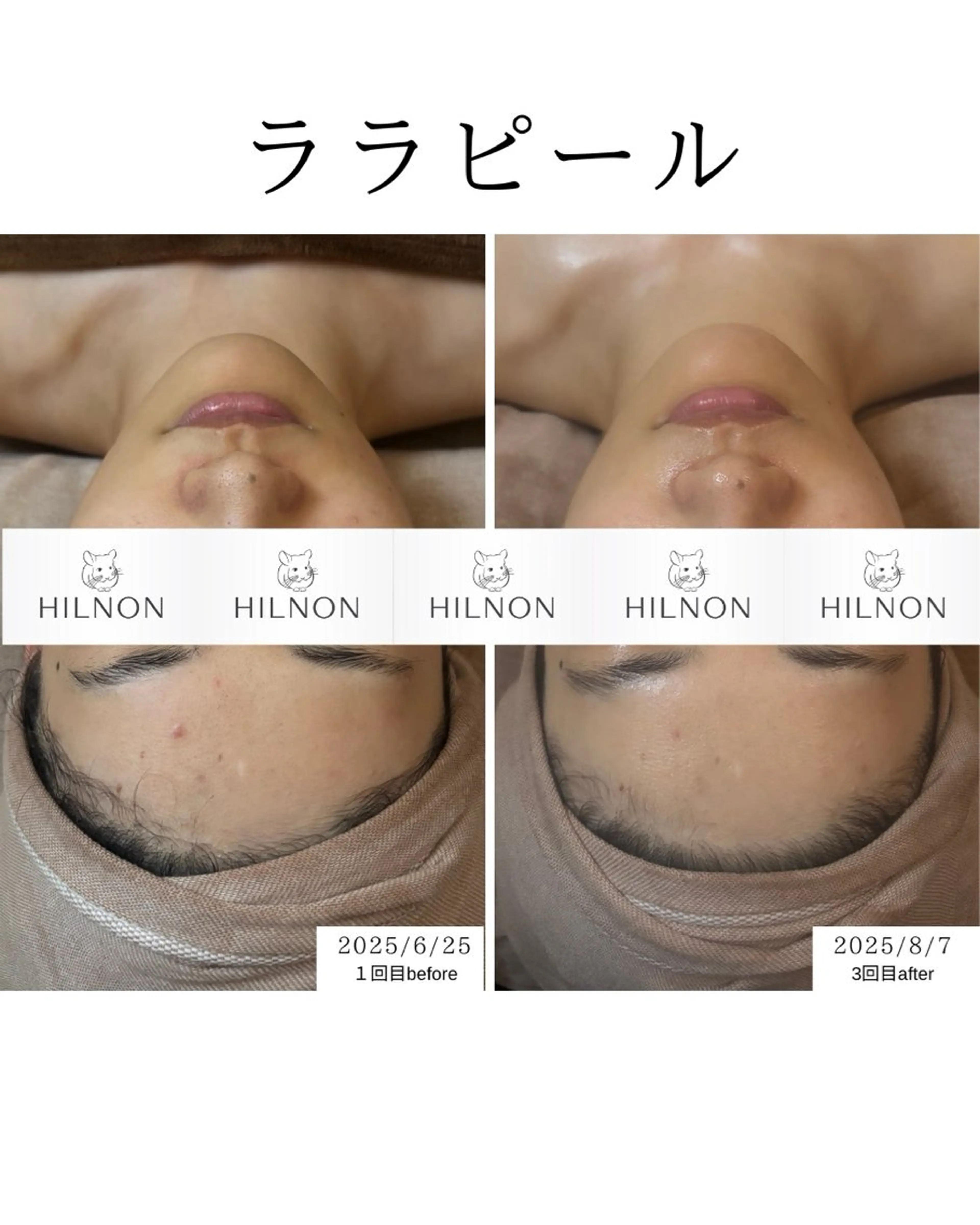 【小顔管理×肌管理】小顔調整＋美顔器×ララピール¥20,800→¥17,500の写真