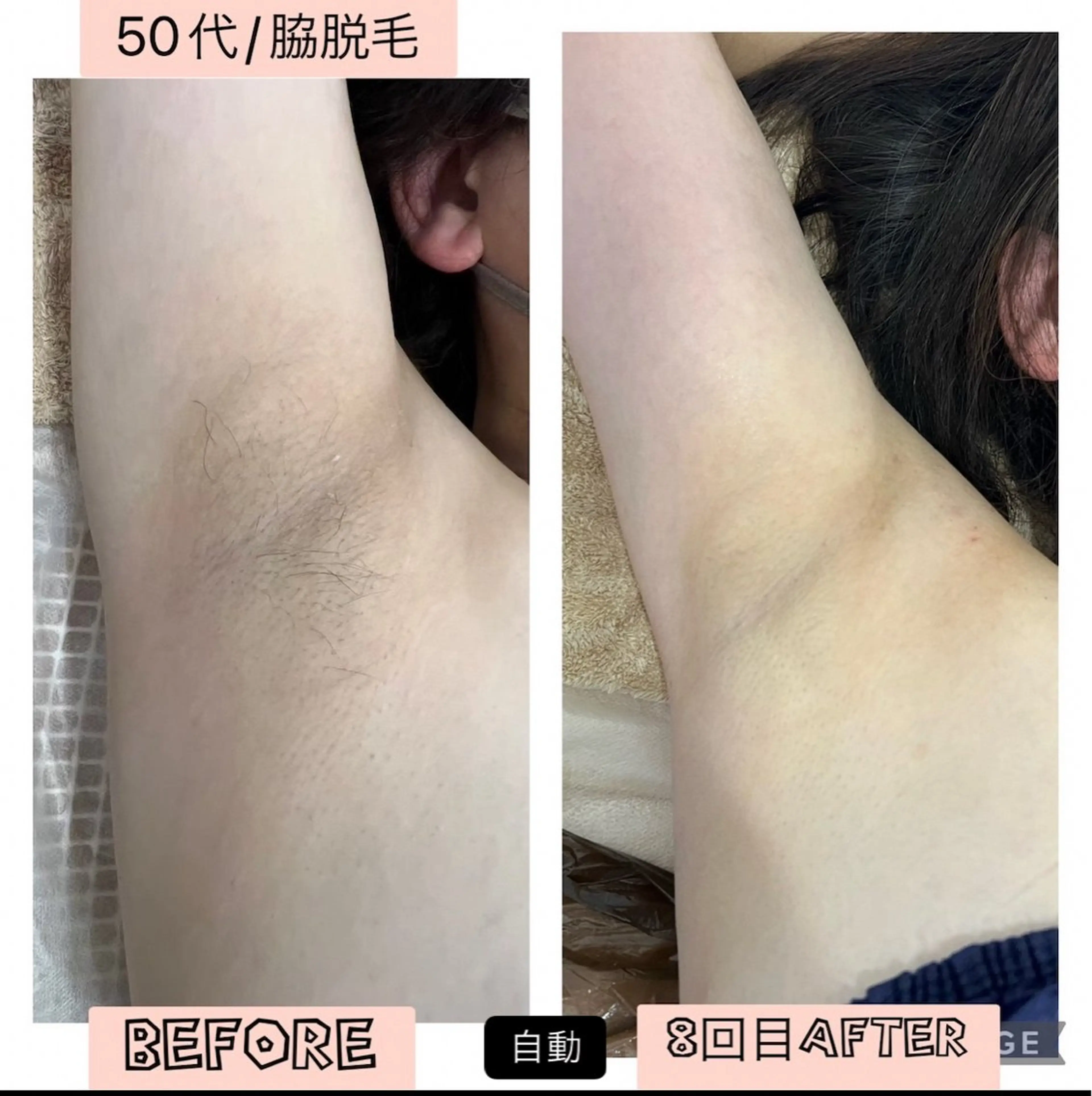 脱毛 ブライダル痩身×脱毛 尼崎駅前サロンのエステ・リラクイメージ