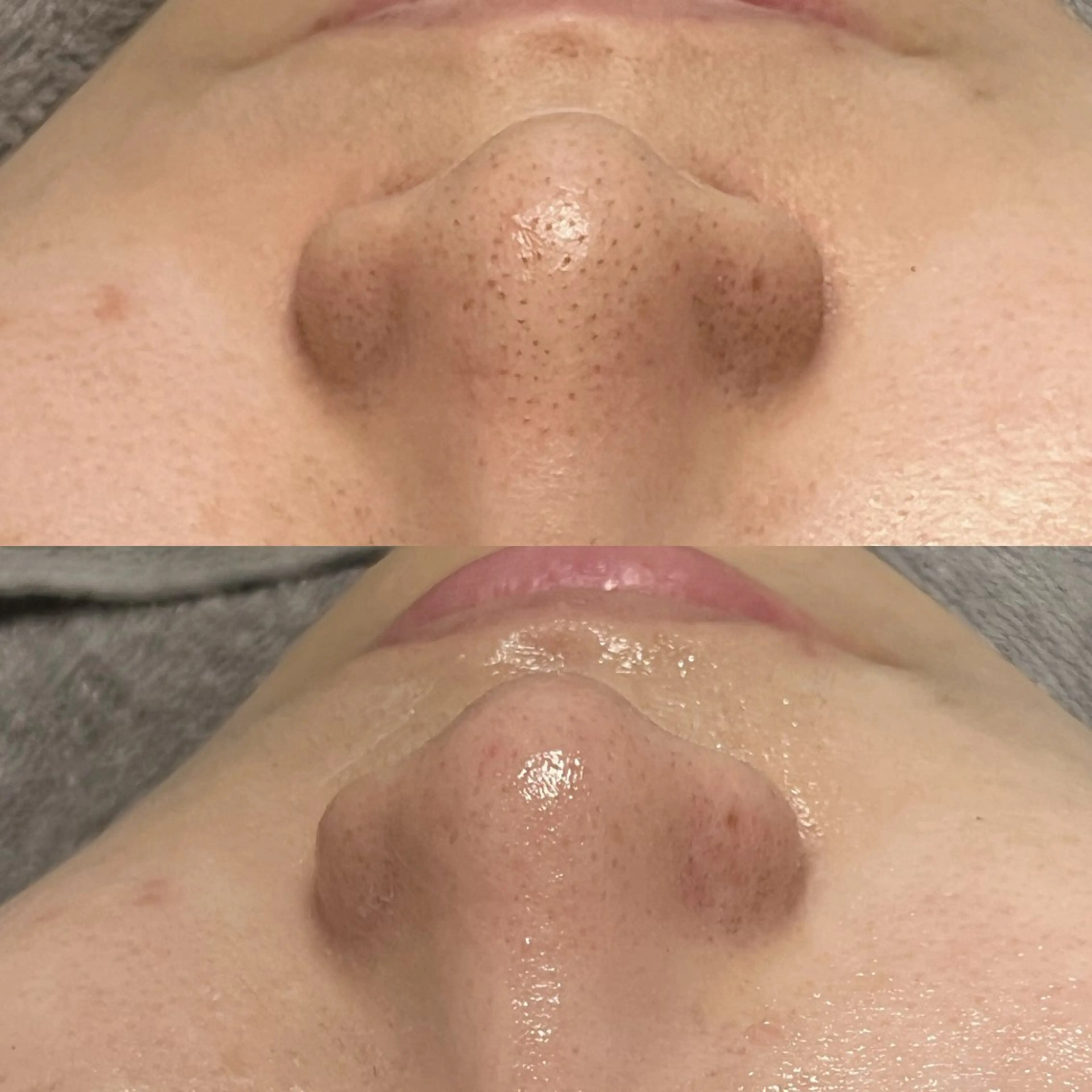 【毛穴スペシャルケア🌟】毛穴洗浄＋部分的WAX（3ヵ所）＋ハイドロジェリー（保湿マスク🫟）の写真