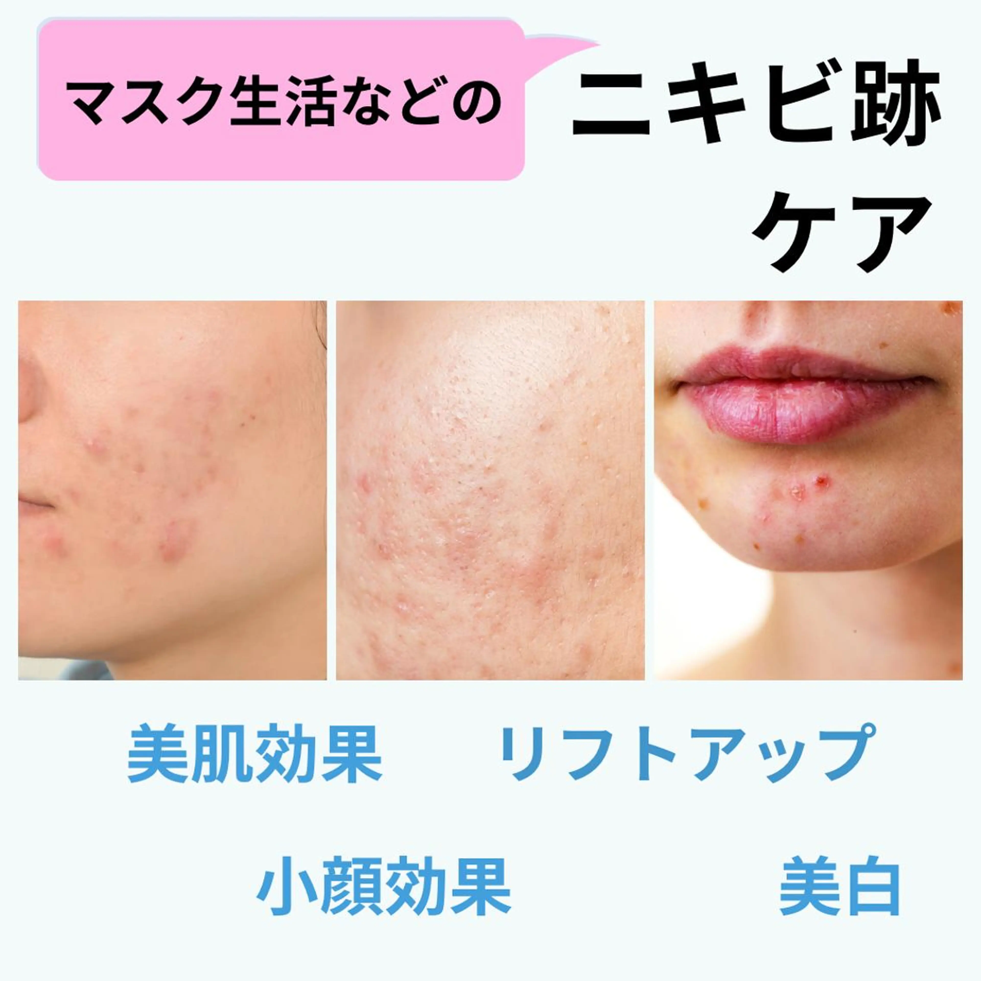 大人気★美白★美肌効果！ニキビ跡ケア！小顔立体光フェイシャル➕美容パックつき！たるみ予防にも！再来店1ヶ月以内の割引の写真