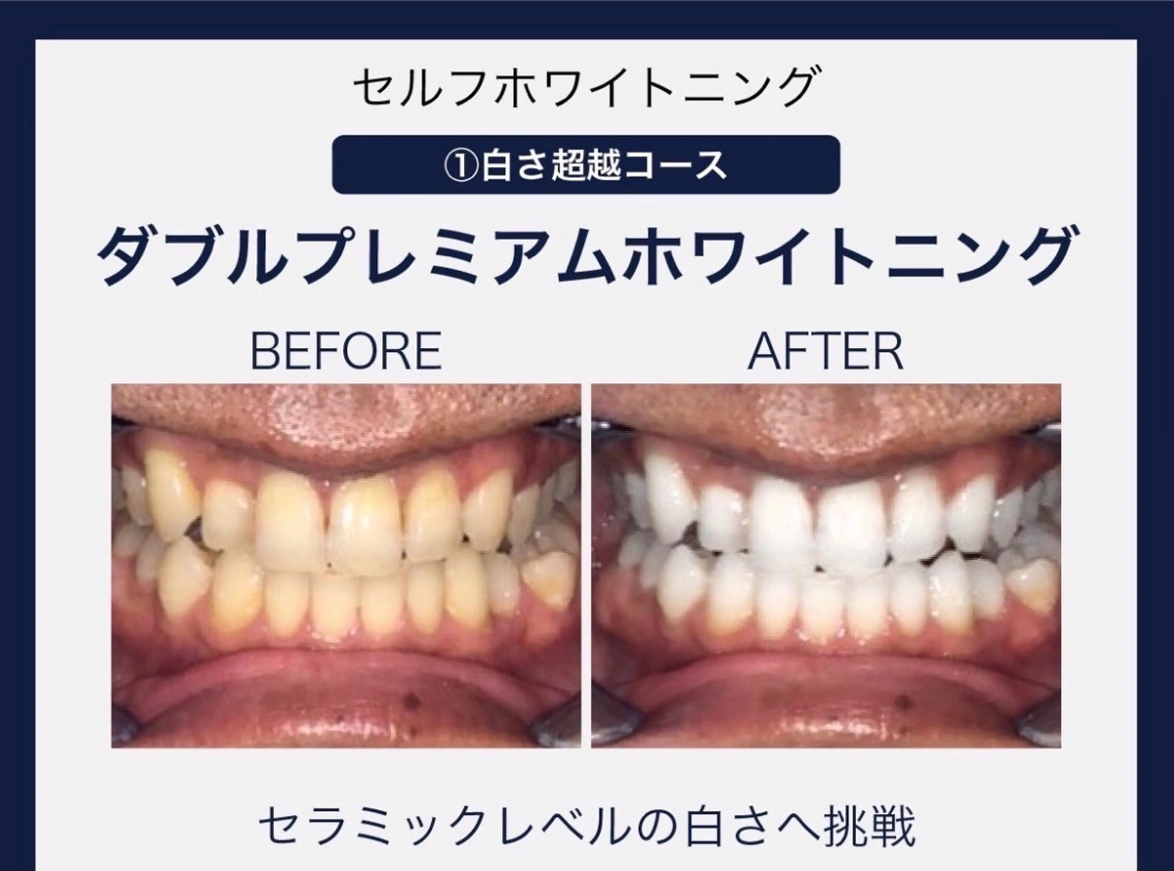 【白さへ挑戦】ダブルプレミアムセルフホワイトニング（4来店型・計160分）の写真