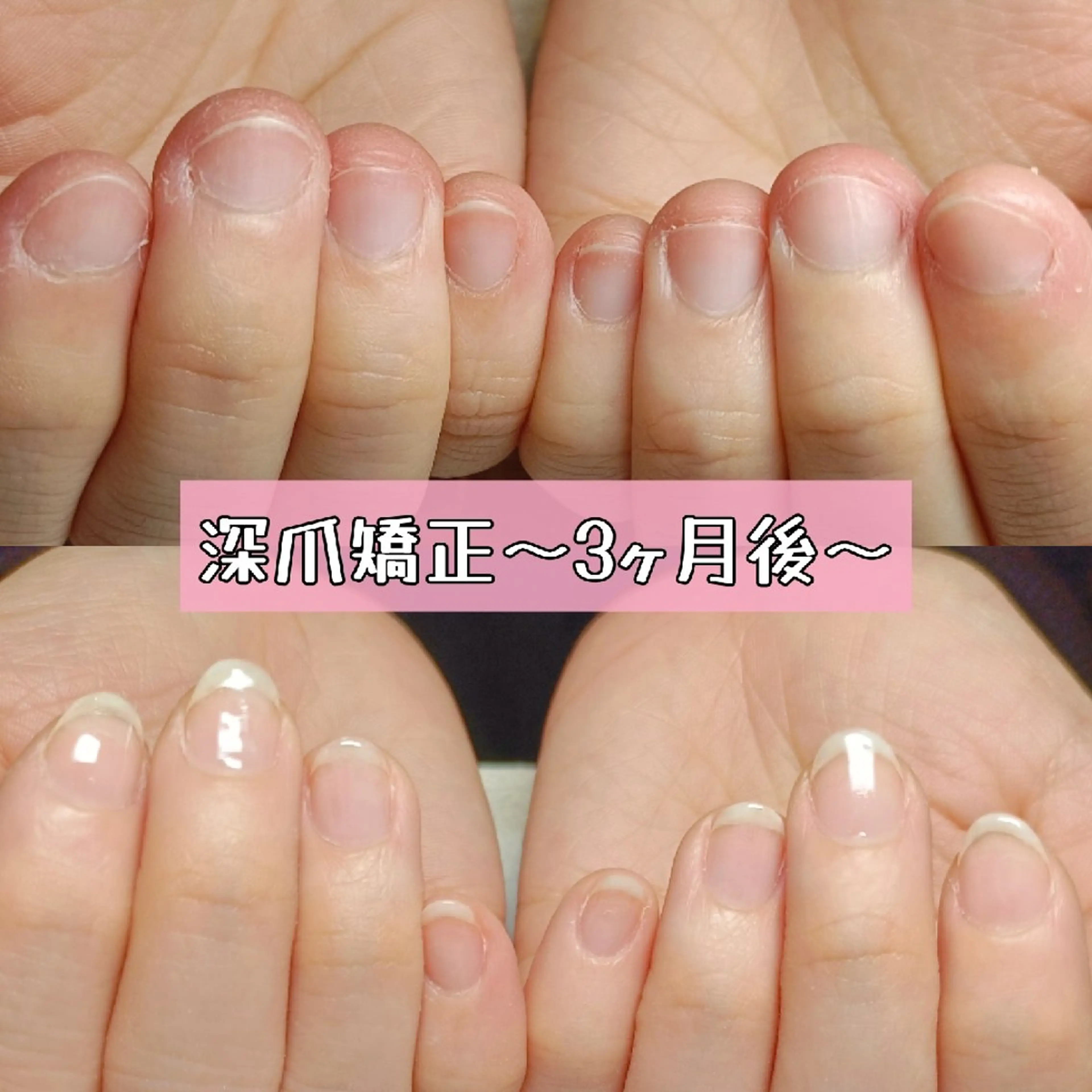 ネイル 長さ出し スカルプネイル ハンドネイル ハンドケア 深爪矯正/爪育成ケア manie nailのネイルデザイン