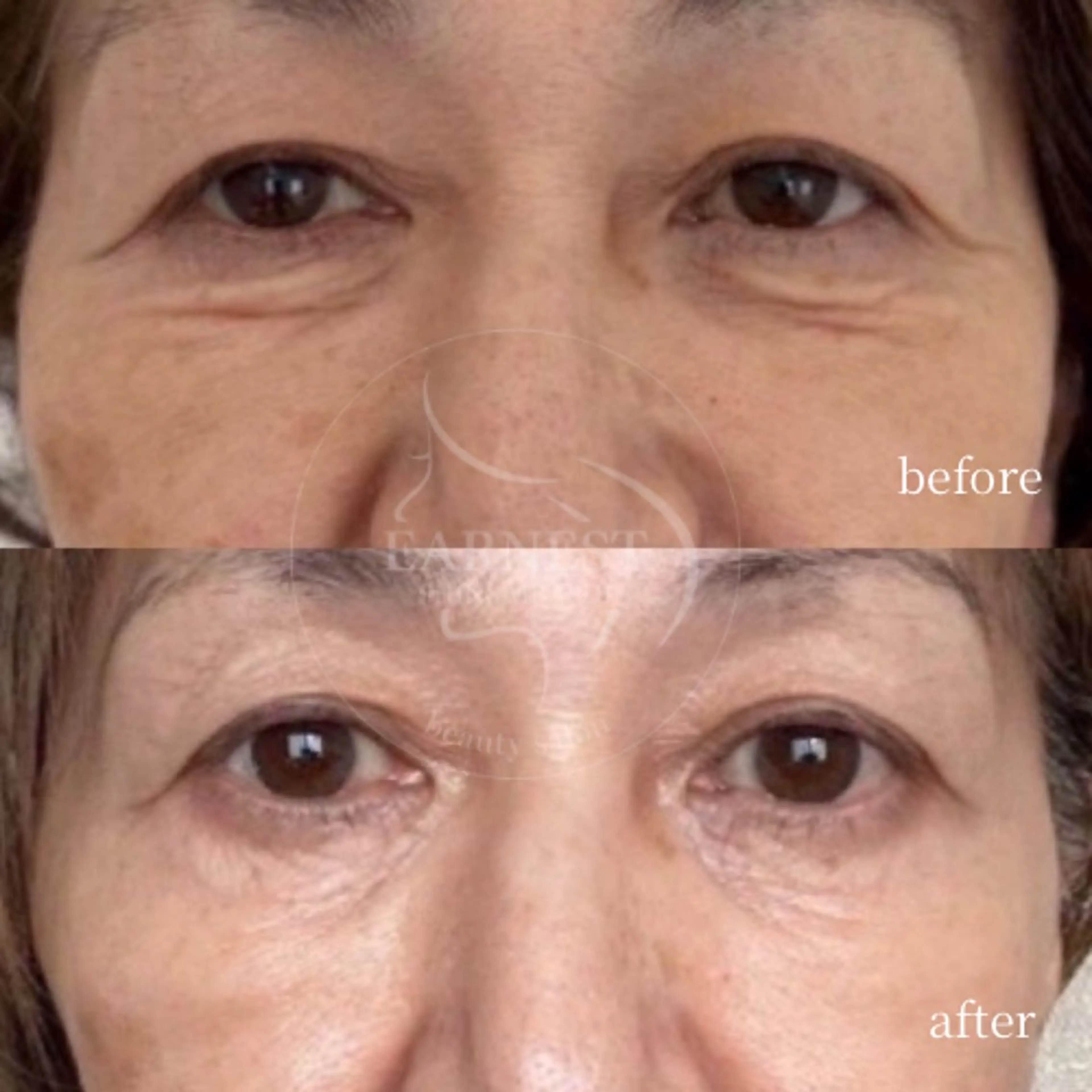 【目元ケア】切らないクマ取り・たるみ改善特化 ◆韓国IR管理 ¥5,500の写真