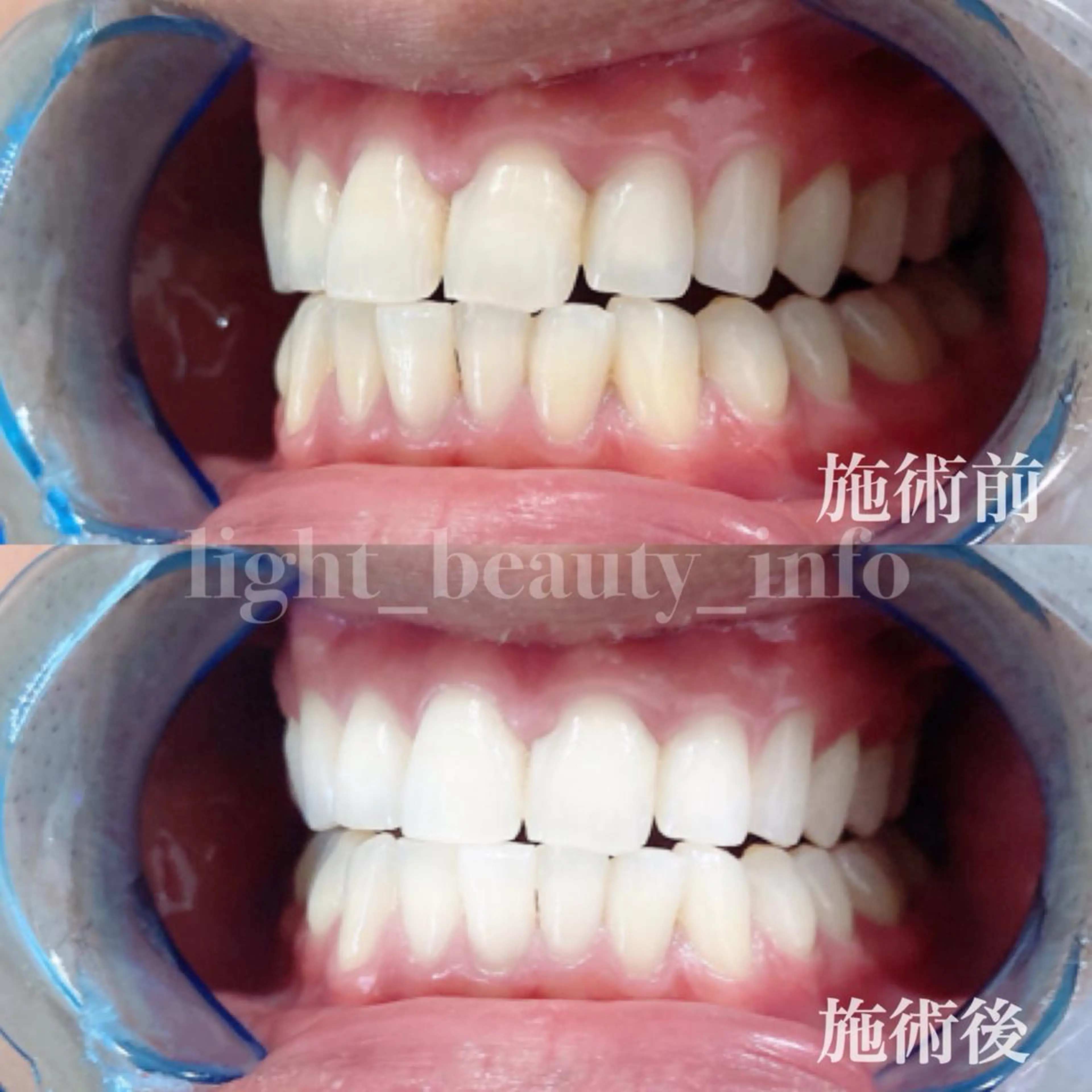 【人気No.2】白さを極める🦷✨プレミアムホワイトニング❤️圧倒的効果🙌🏻〈合計2来店70分照射コース〉🦷✨の写真