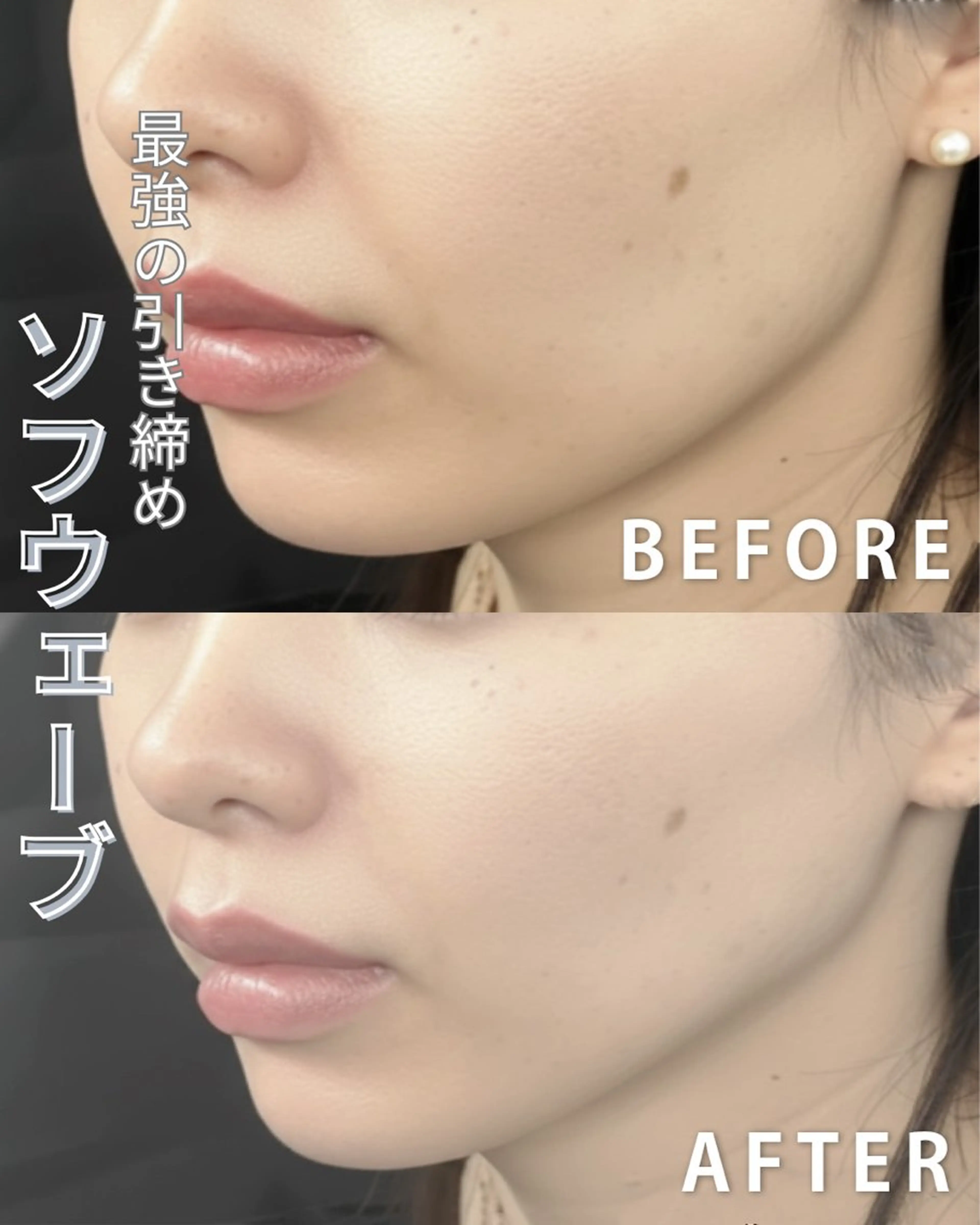 【最強小顔】Vリフト×高濃度ハリ成分×プラズマ導入でたるみ・小じわ改善の写真