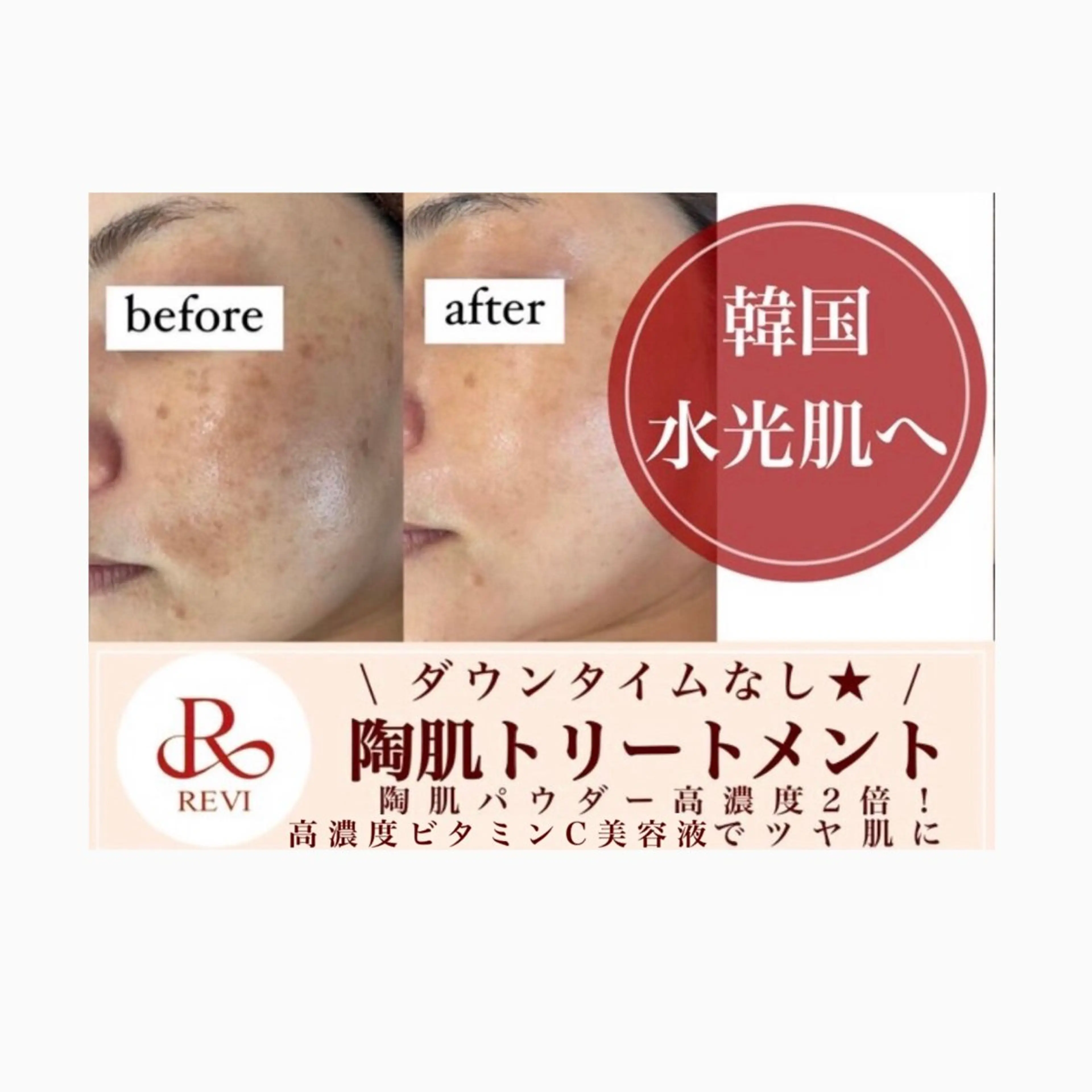 🌿REVIハーブピーリング🌿➕高濃度ビタミンC美容液の写真