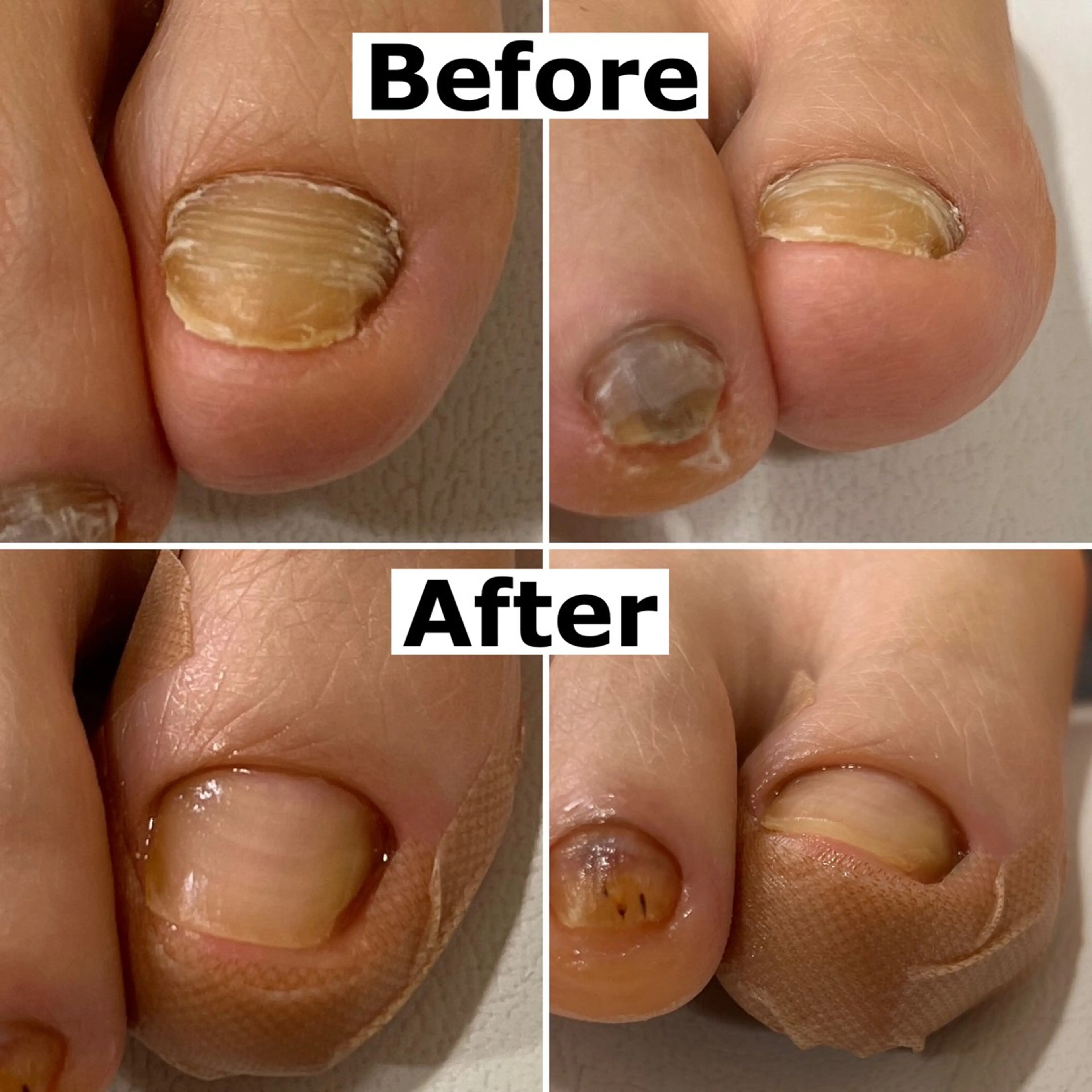 ネイル Mellow nail所属・巻爪無料モデル募集 ✨🦶MEGUMIのネイルデザイン