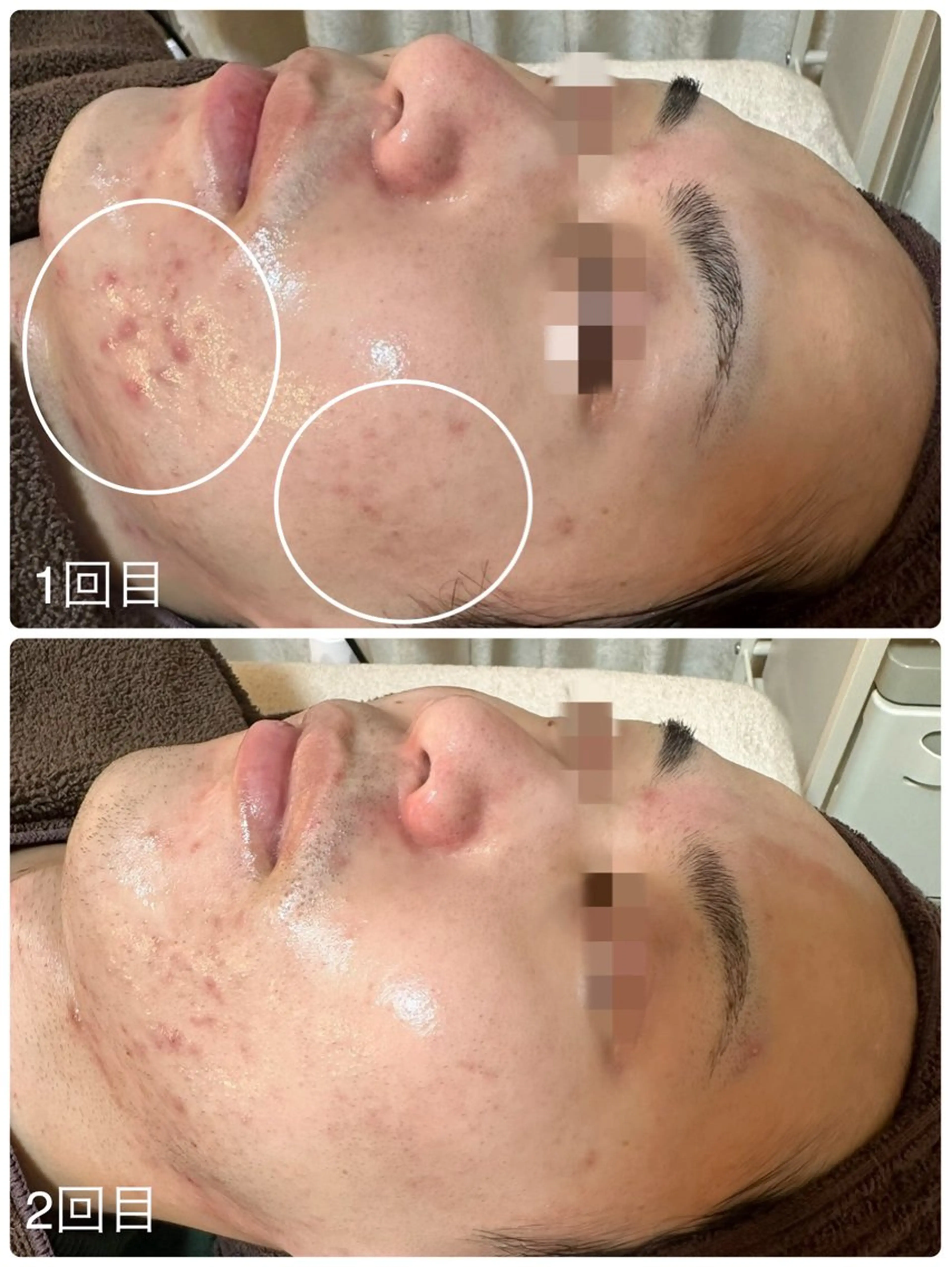 【モニター（男性）/ニキビケア】水光プラズマでニキビの素のアクネ菌を殺菌！赤ニキビ、凸凹肌におすすめです。の写真