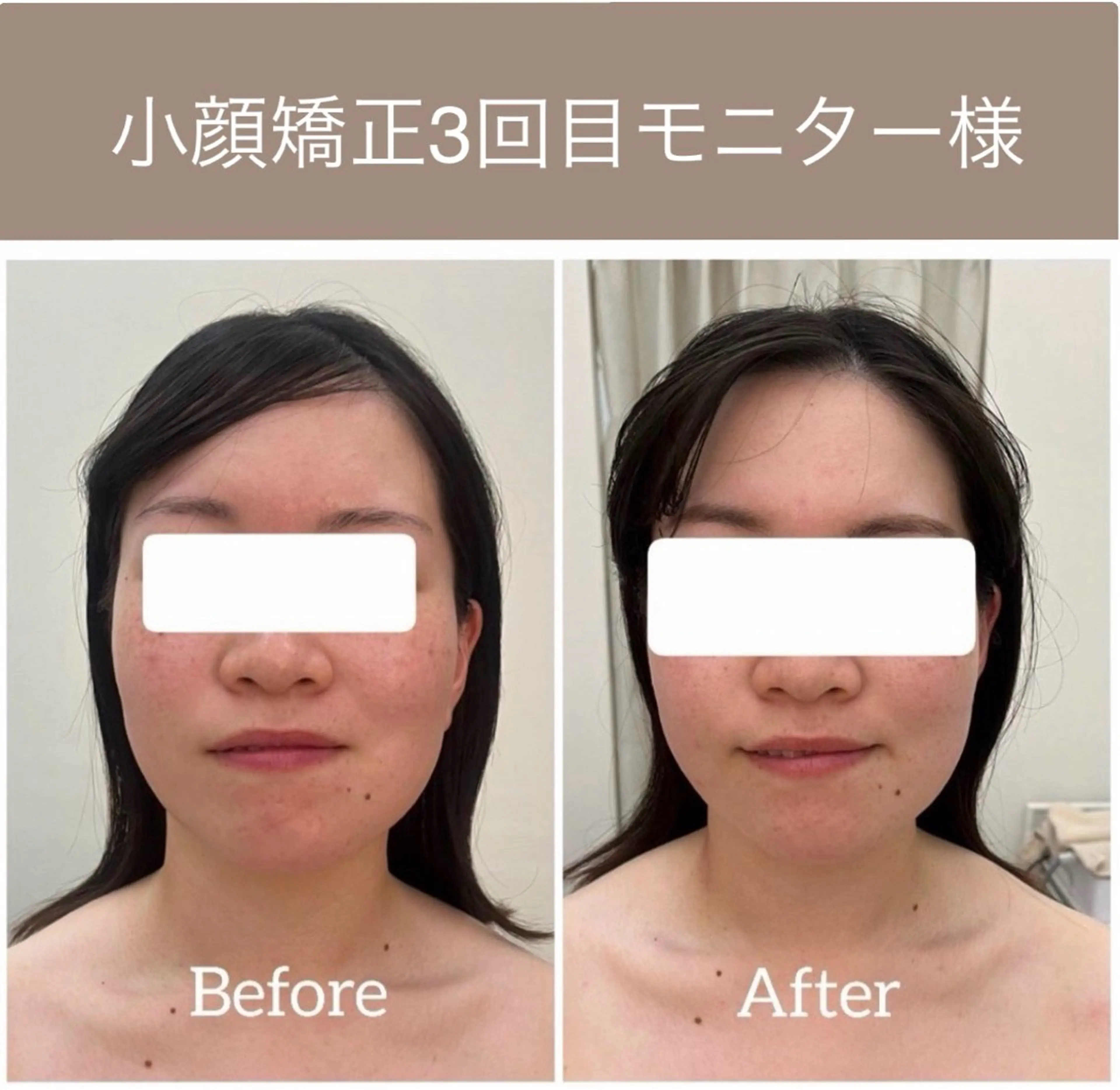 小顔体験モニター✨ ¥1,100モニター♪《条件：全顔出し、ビフォーアフター翌朝の写真、口コミをしてくださる方限定❗️》の写真