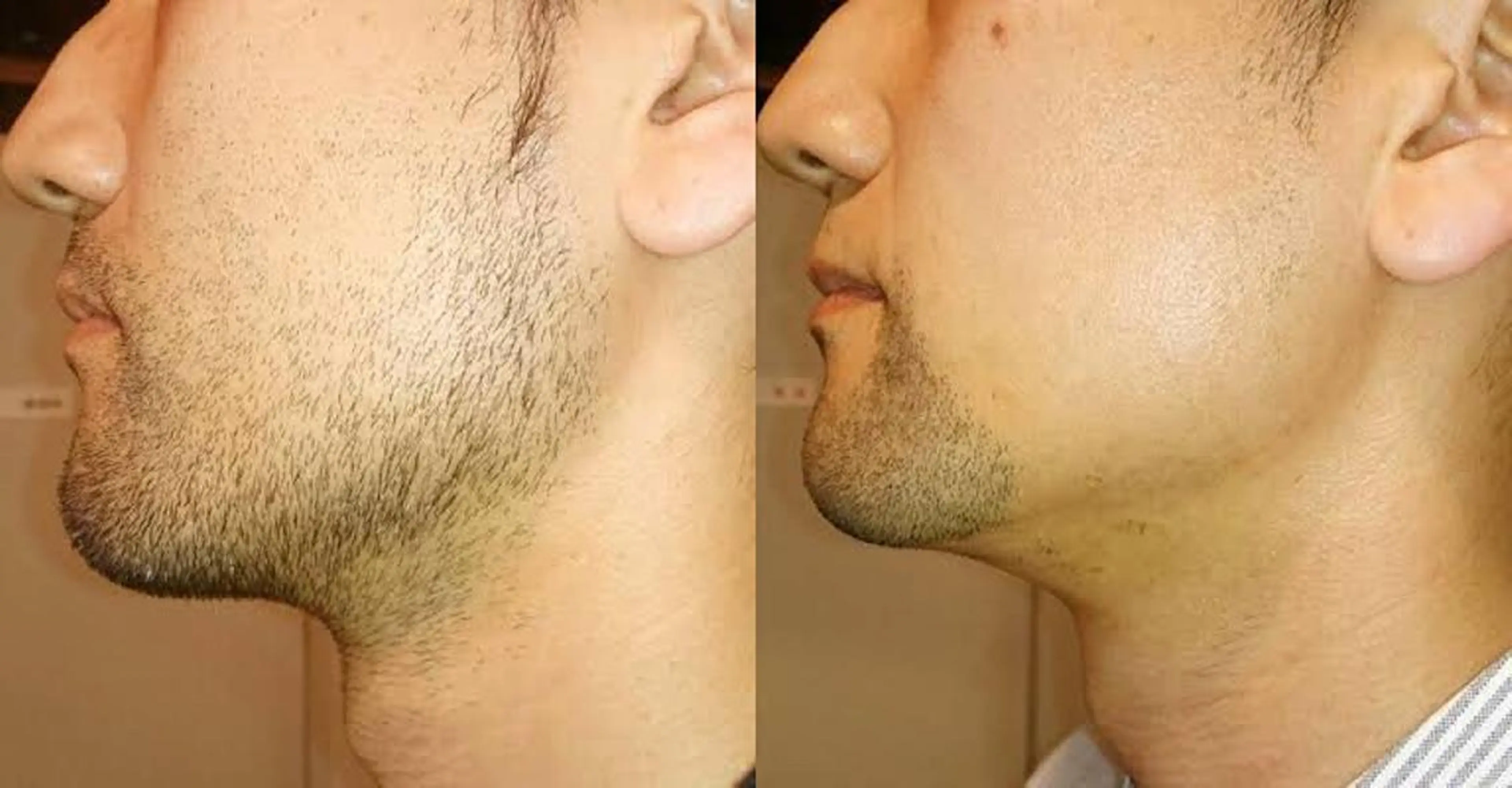 【口コミ割】人気No. 1👑メンズヒゲ脱毛1000円🧔の写真