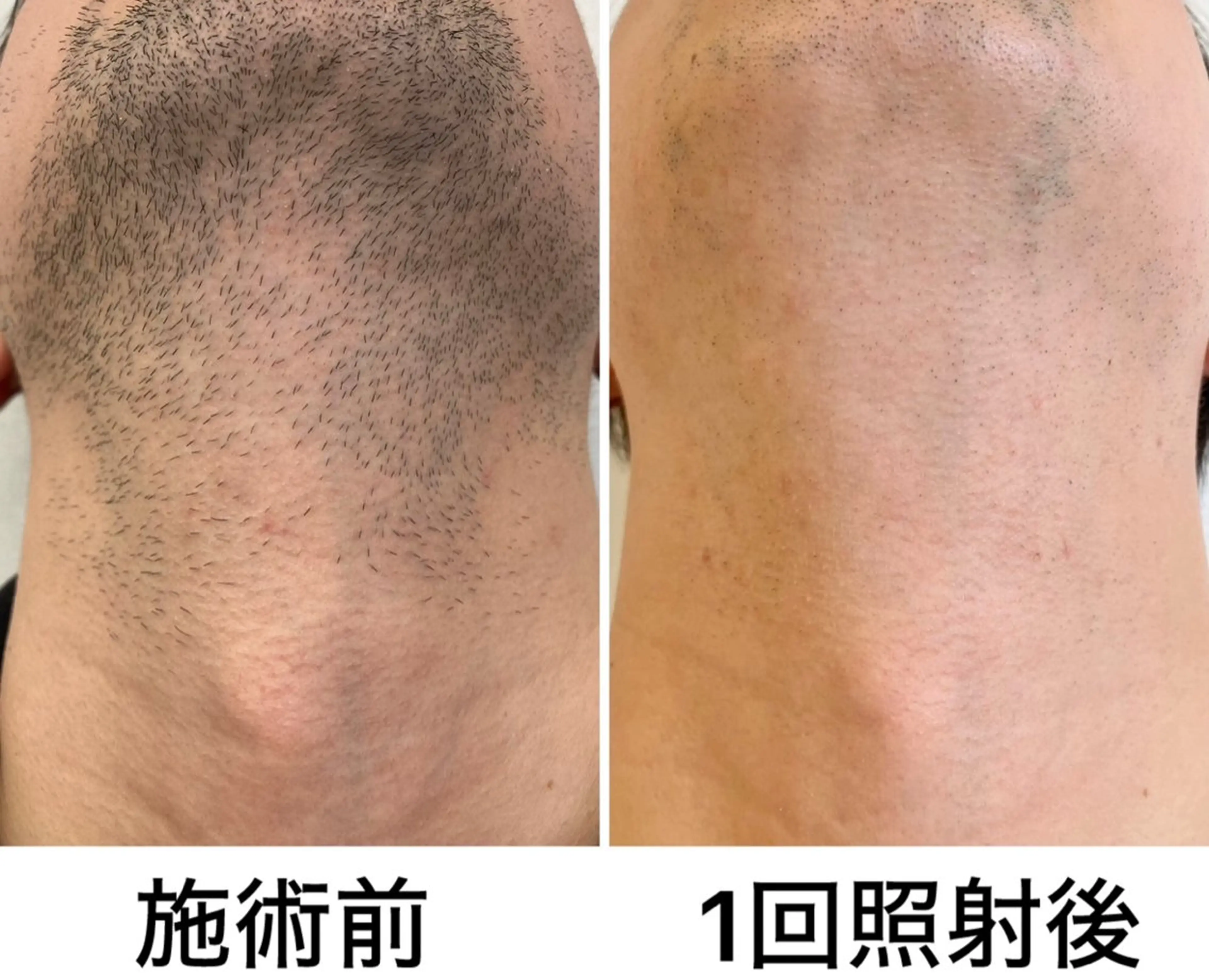 メンズ エステ RESON 調布店所属・都度払いの脱毛サロン RESONのエステ・リラクイメージ