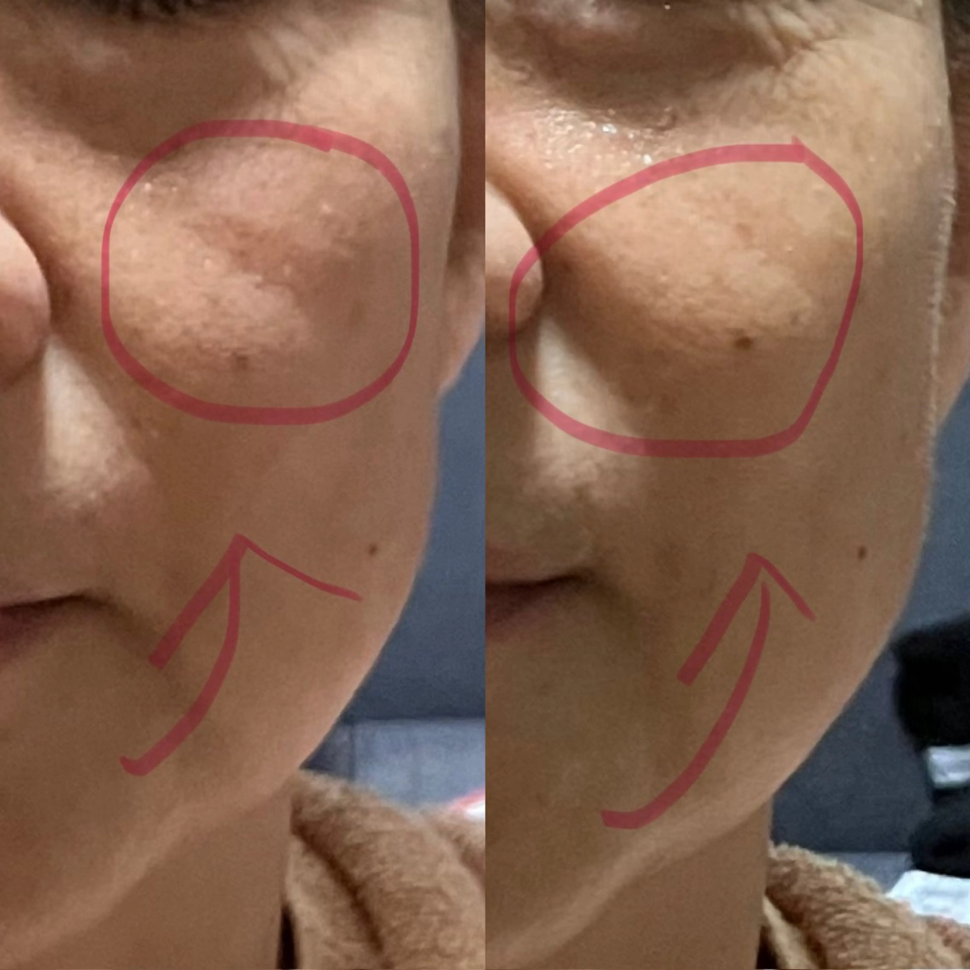 【憧れ小顔】✨リフトアップ超音波エステ💆‍♀️キメを整え、たるみ、シミシワにもアプローチ。の写真