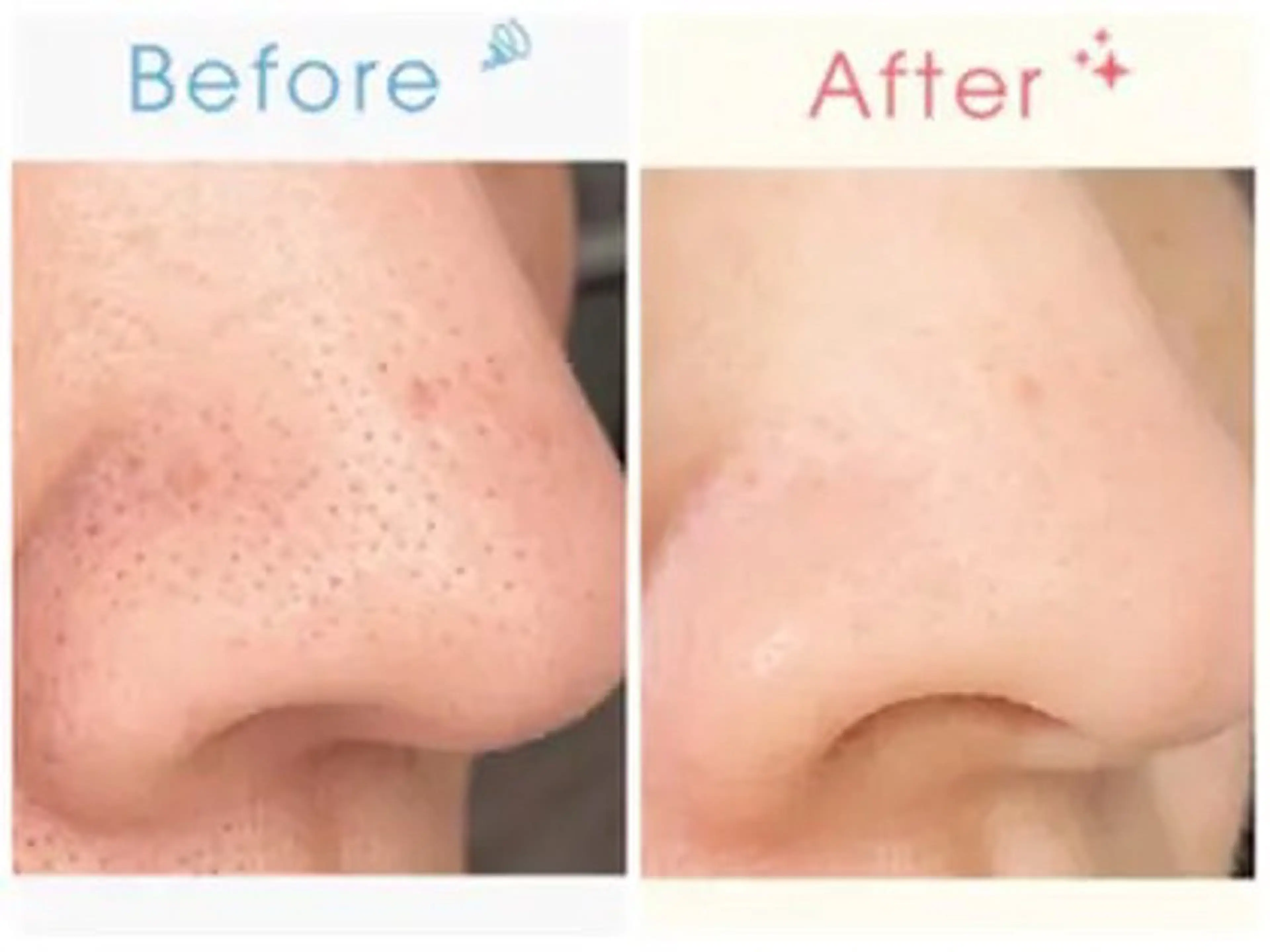 毛穴洗浄 鼻のみ✨の写真
