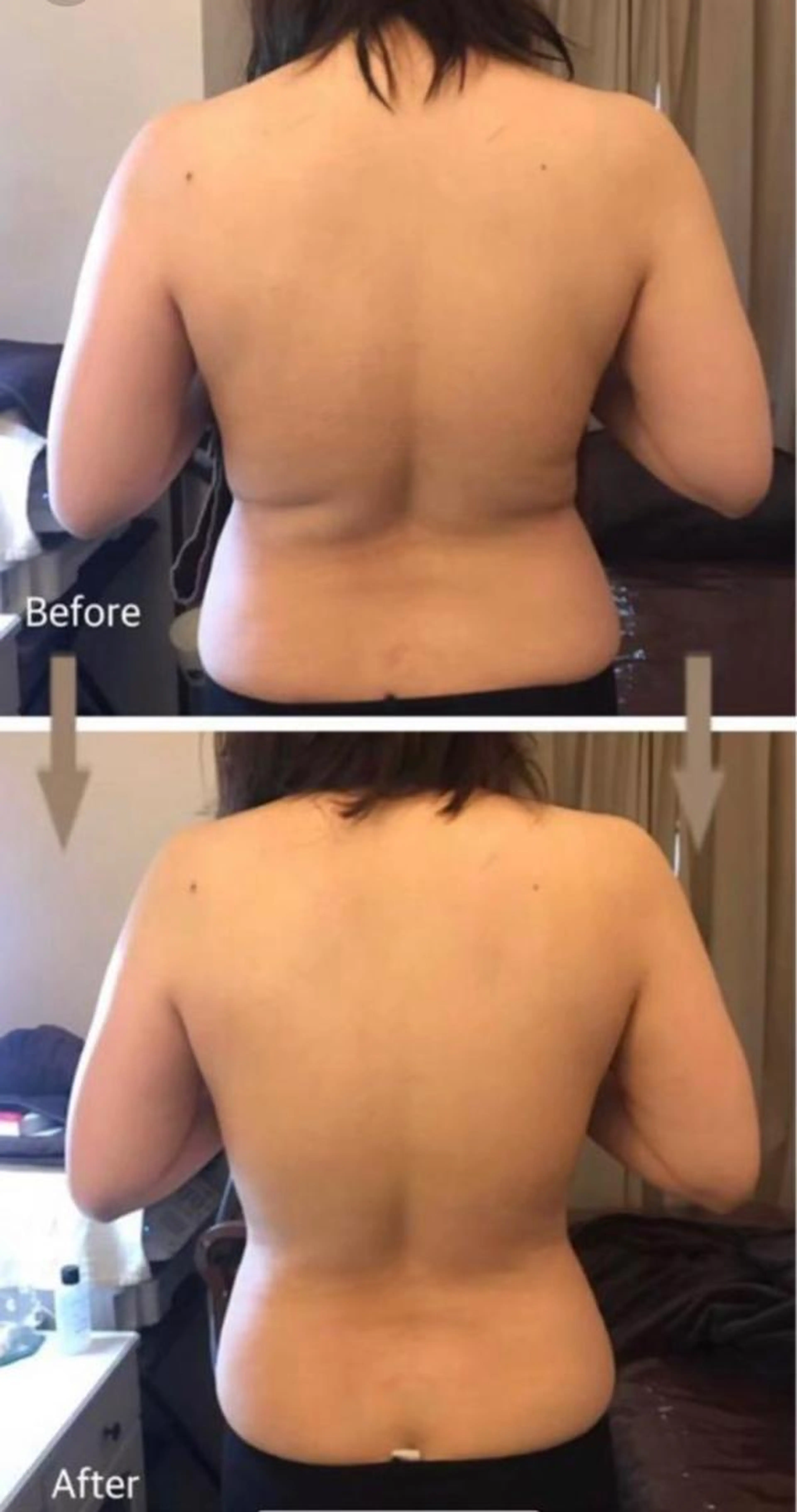 【女性のみ🙆‍♀️背中＆腰回りケア】セルライトケアコース&保湿ケア付きの写真