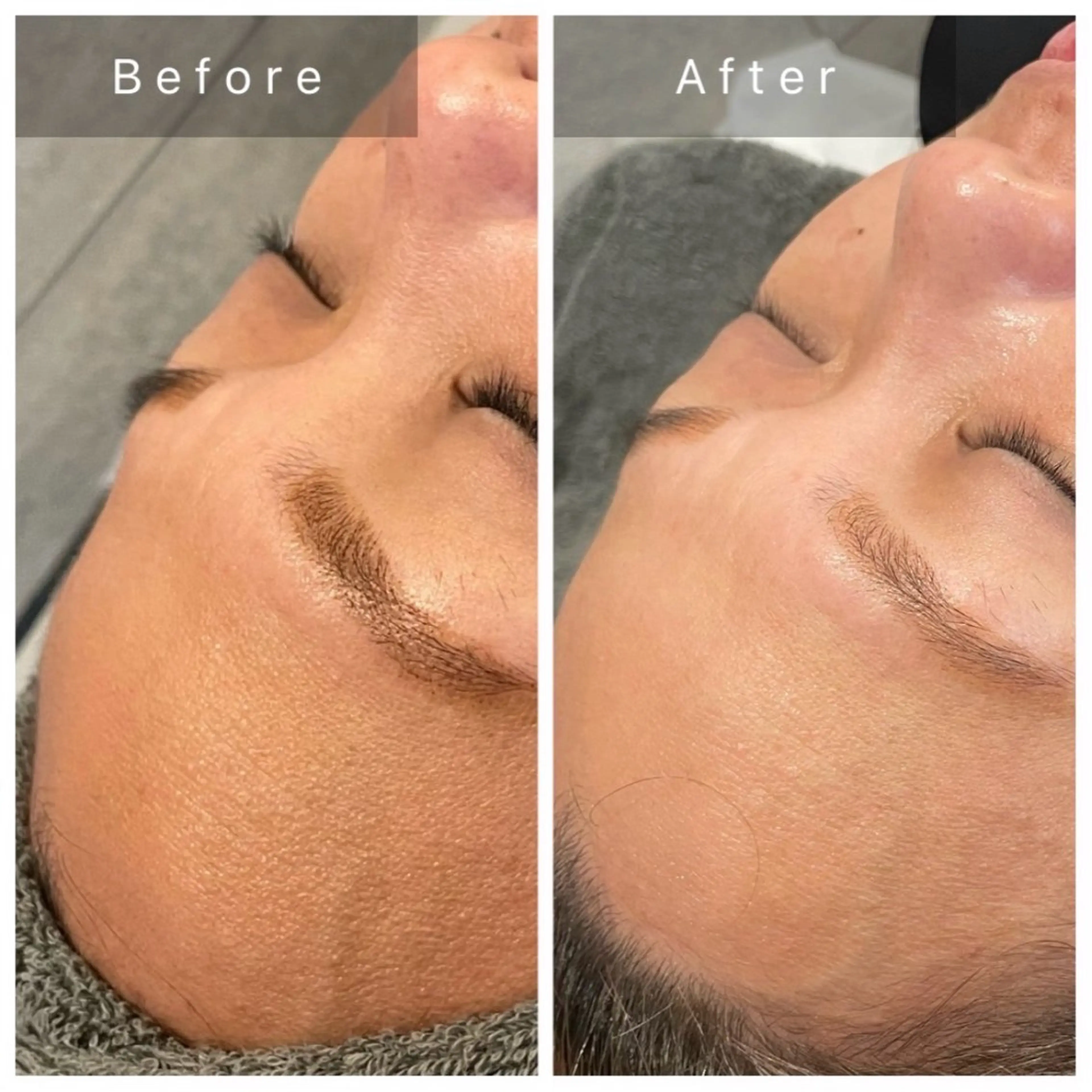 【✨1日1名様限定✨】最強小顔SET+ブラックピール‼️の写真