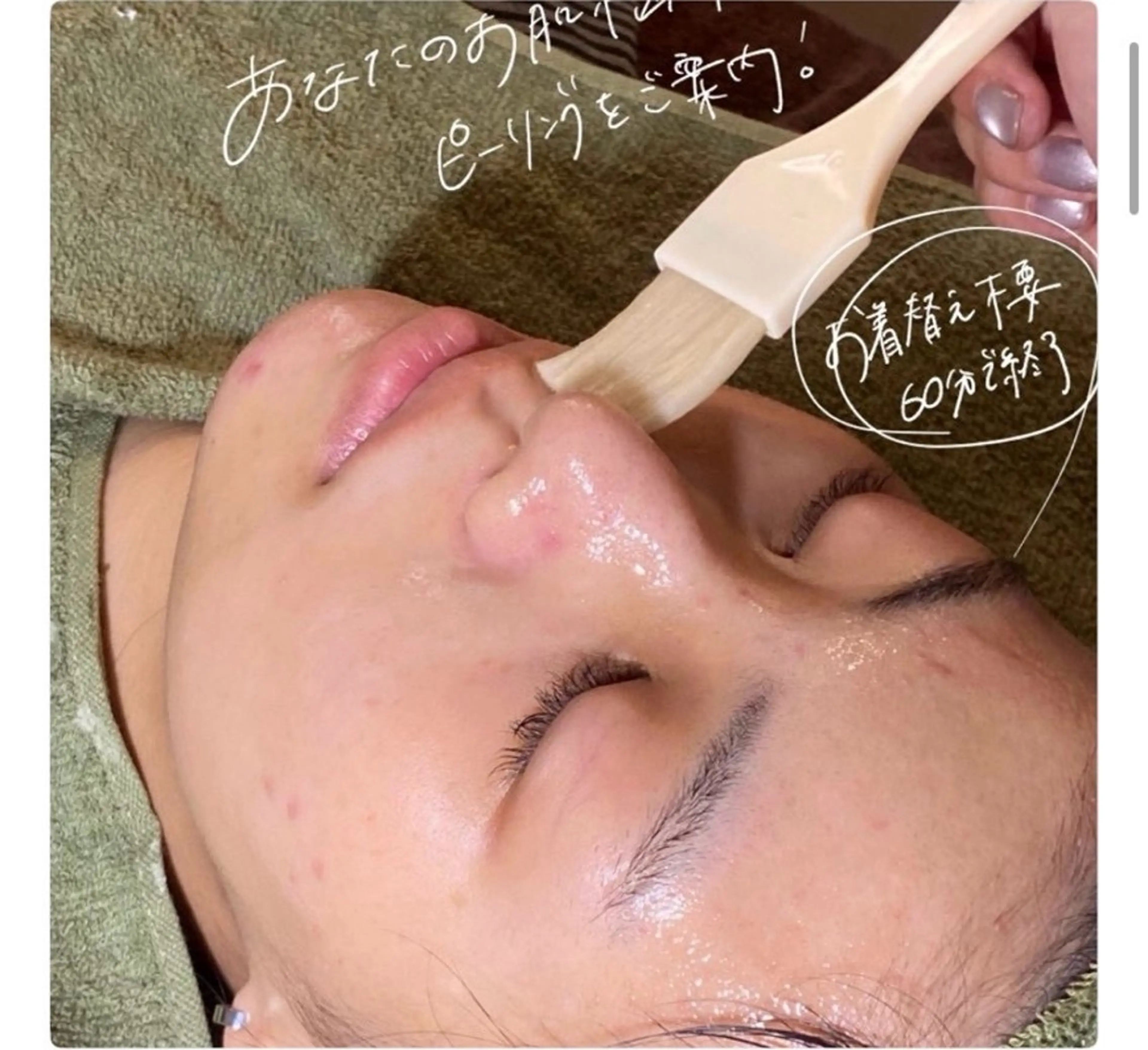 【今すぐに効果を感じたい方へ!】リセットピーリング40分 ［ニキビ/ニキビ跡/シミ/ざらつき/角栓/毛穴の開き］の写真