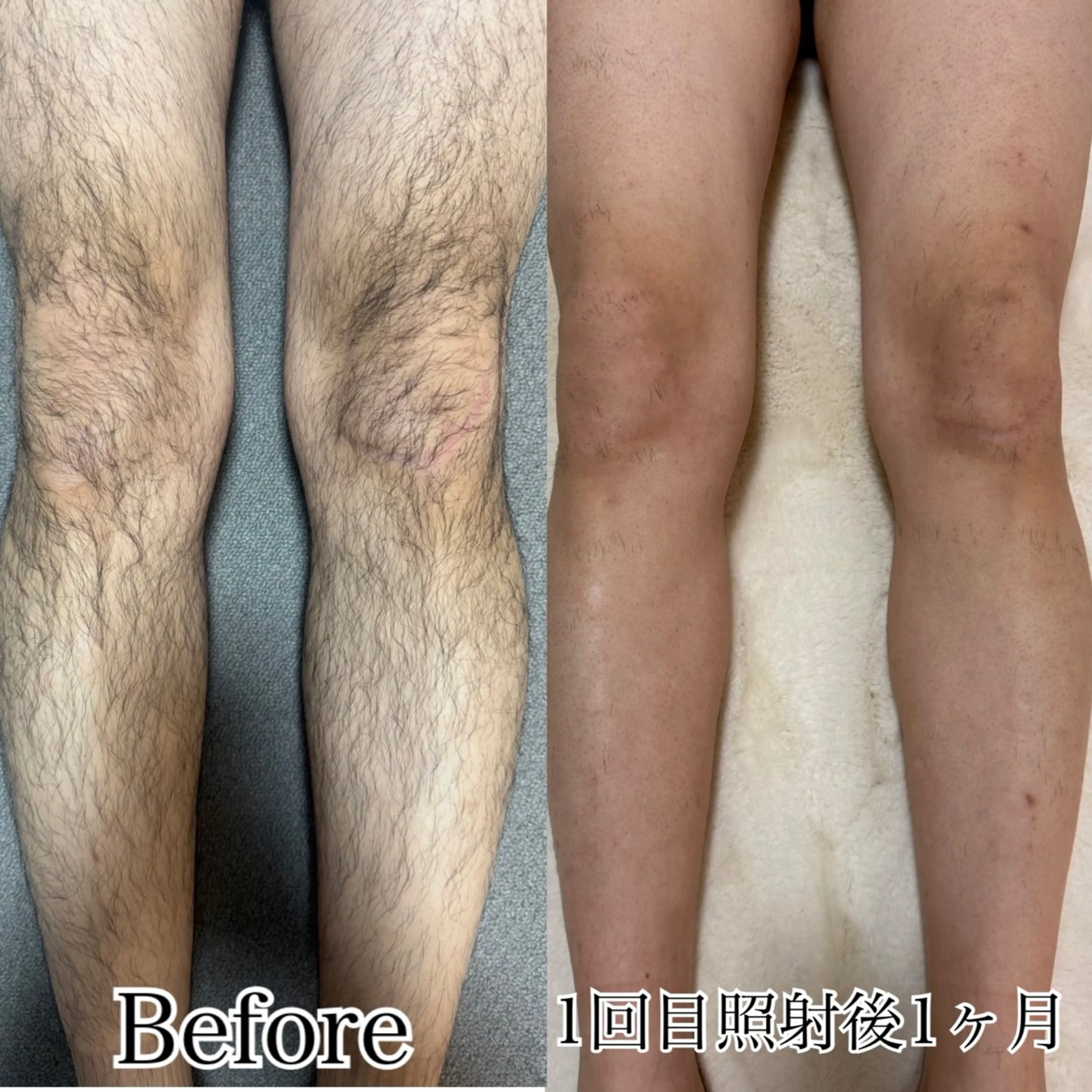 men'sひざ下・ひざ上脱毛の写真