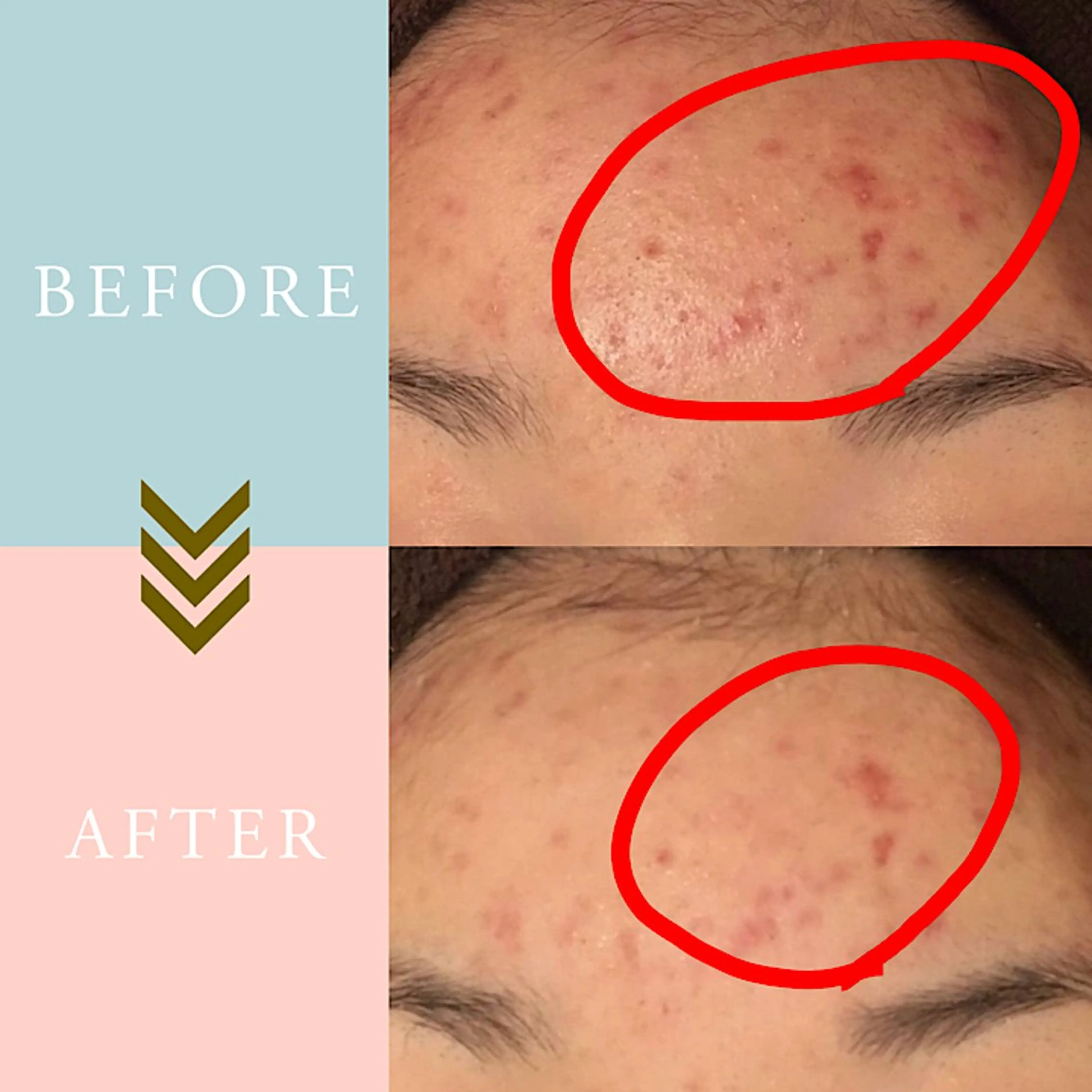 ニキビケア/毛穴/ 赤み/自信の肌✨森園のエステ・リラクイメージ