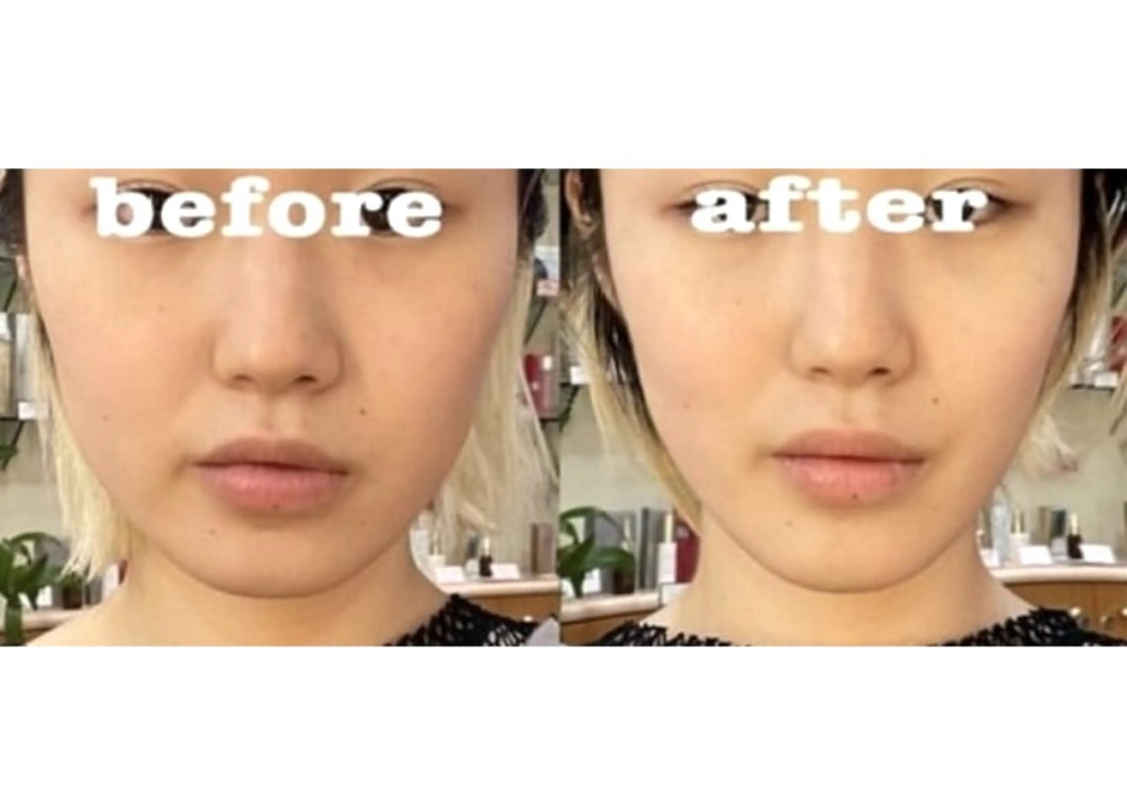 シワたるみケア⤴︎美肌光フォトRF✨《パック付》の写真