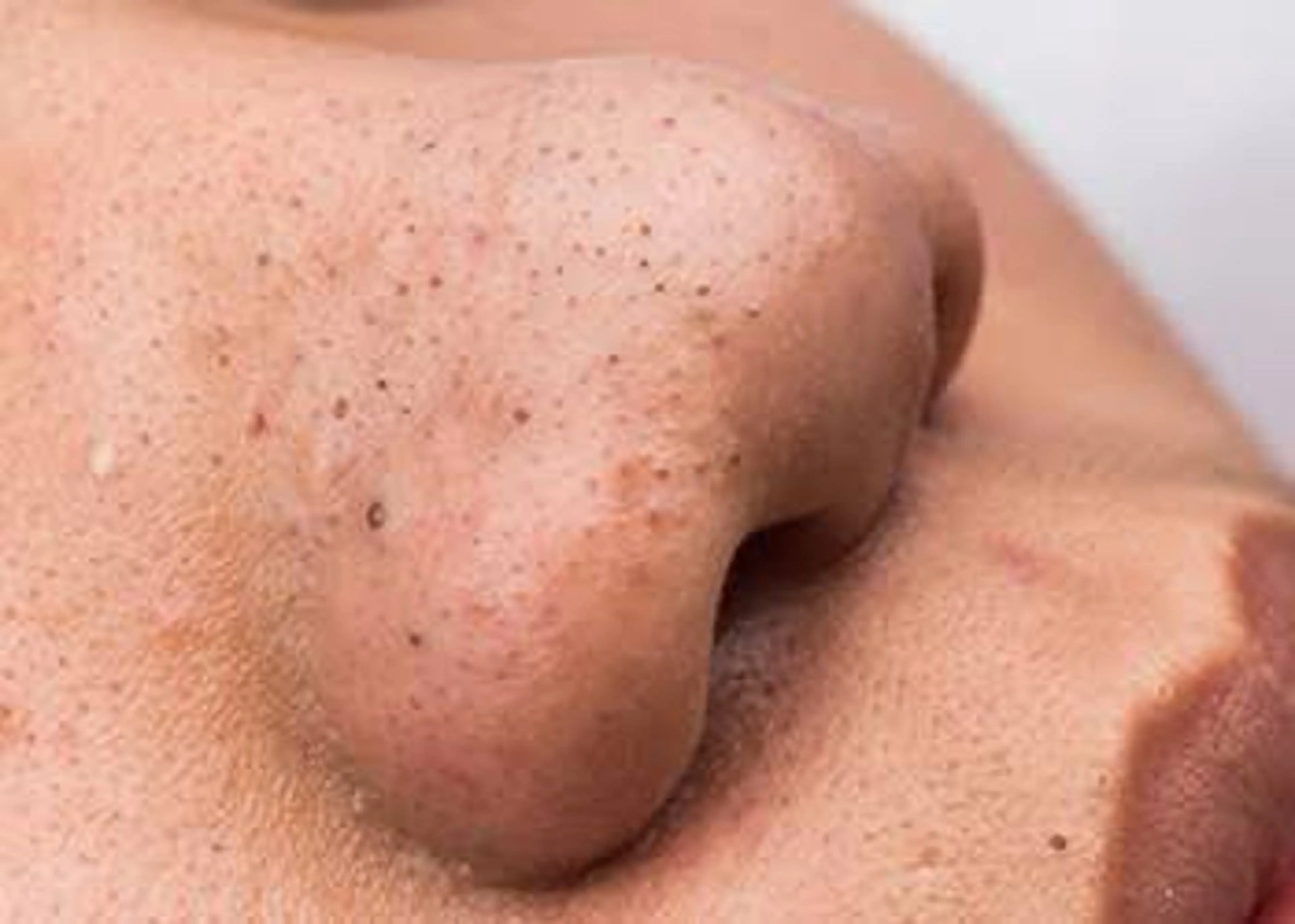 【本日限定‼️黒ずみ/毛穴詰まり】鼻　毛穴洗浄トルネード洗浄の写真