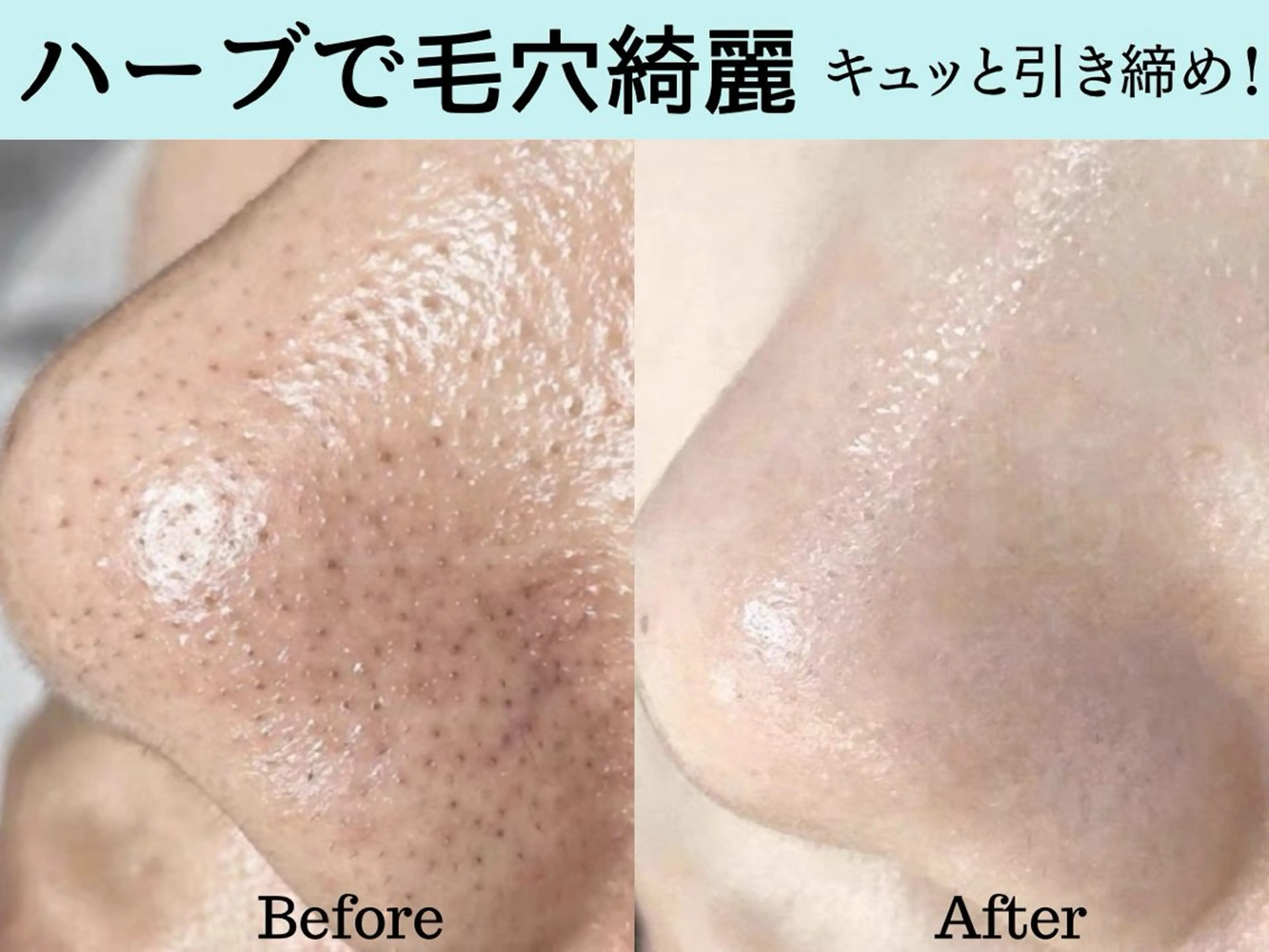 【新宿店限定】剥離なしソフト×毛穴洗浄✨ハーブピーリング💚酸不使用！最高峰の針を使用◎根本改善💓の写真