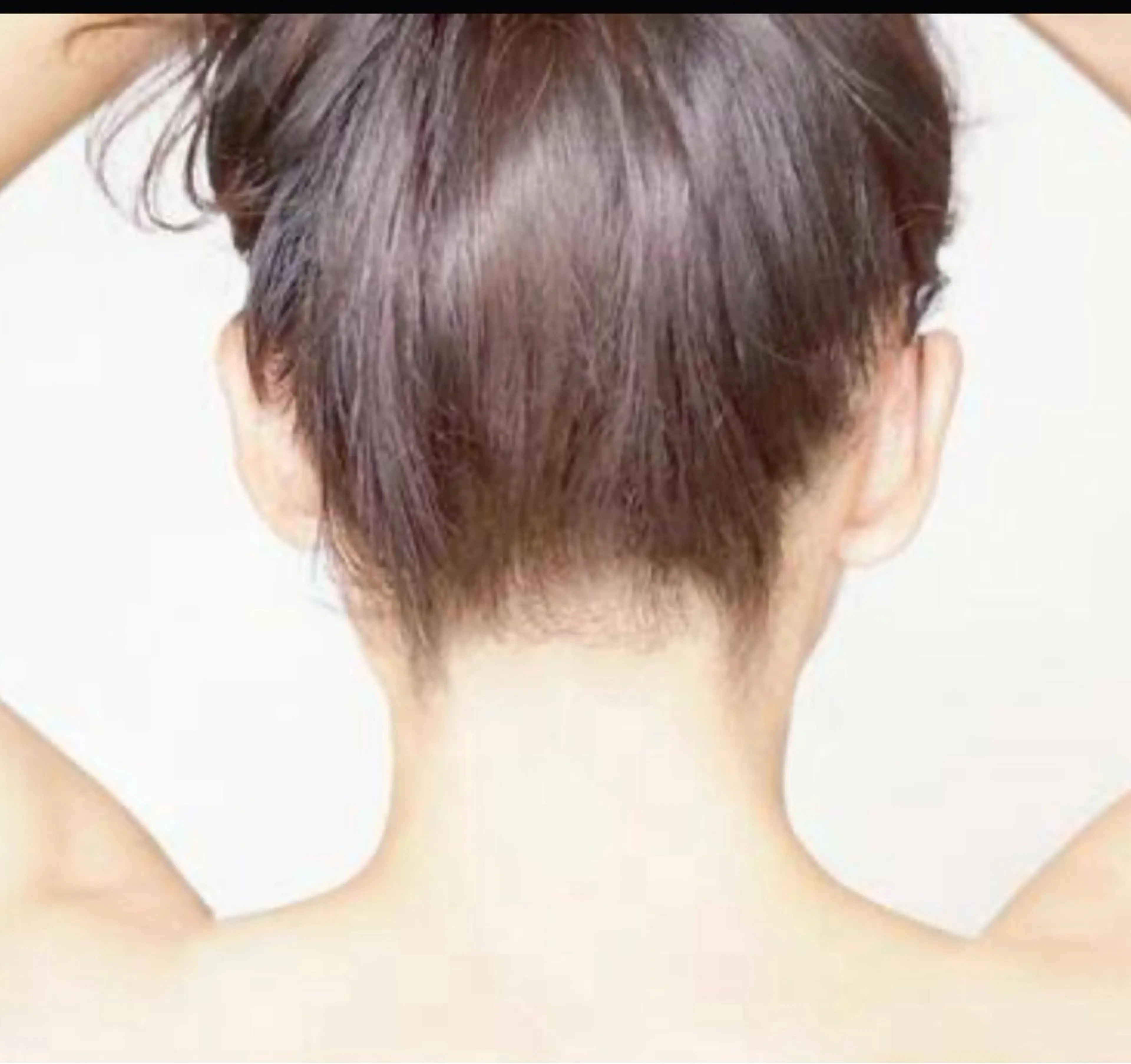 顔、うなじ脱毛の写真