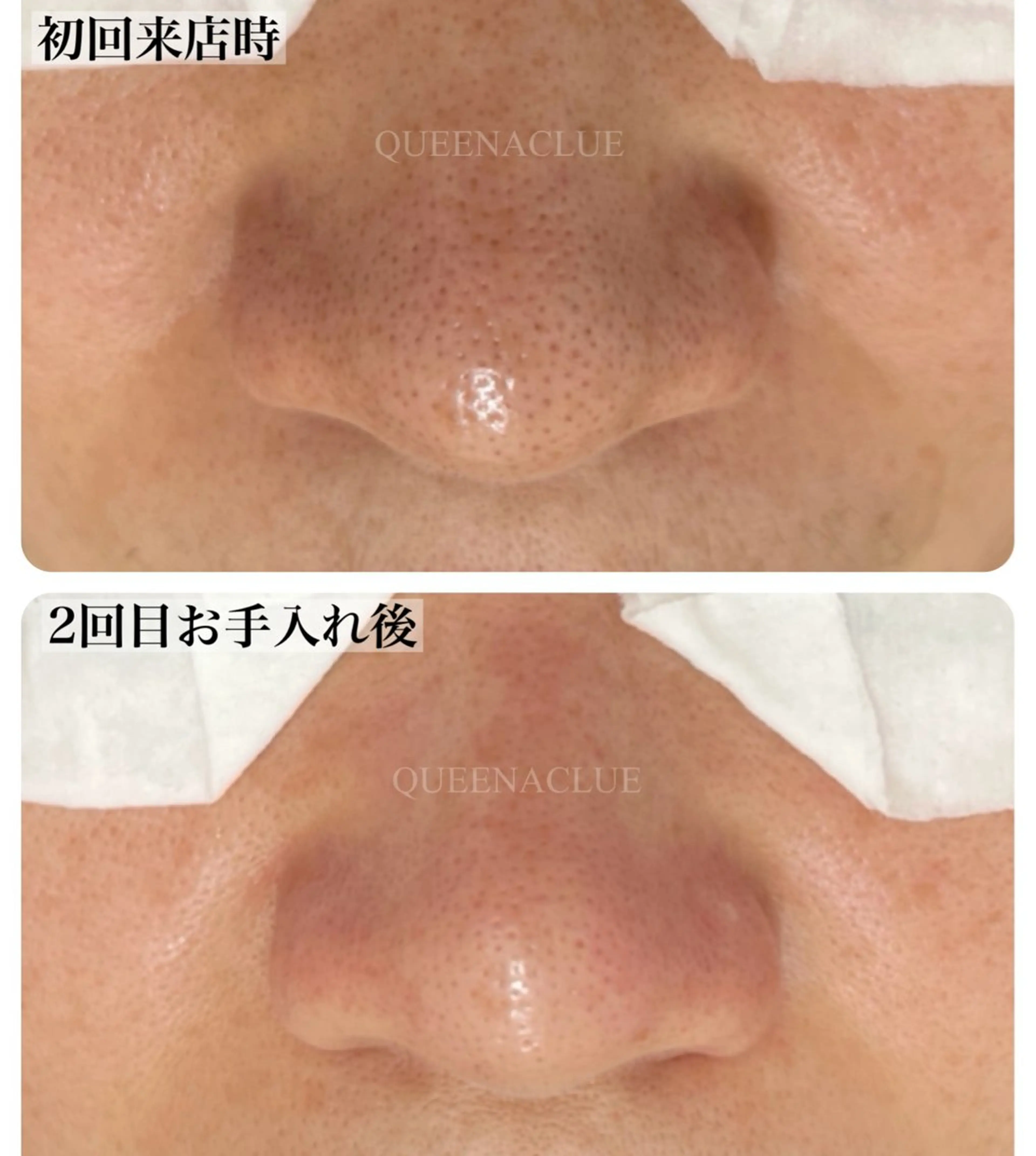 毛穴改善/脱毛 ネイル 川上久仁子のエステ・リラクイメージ