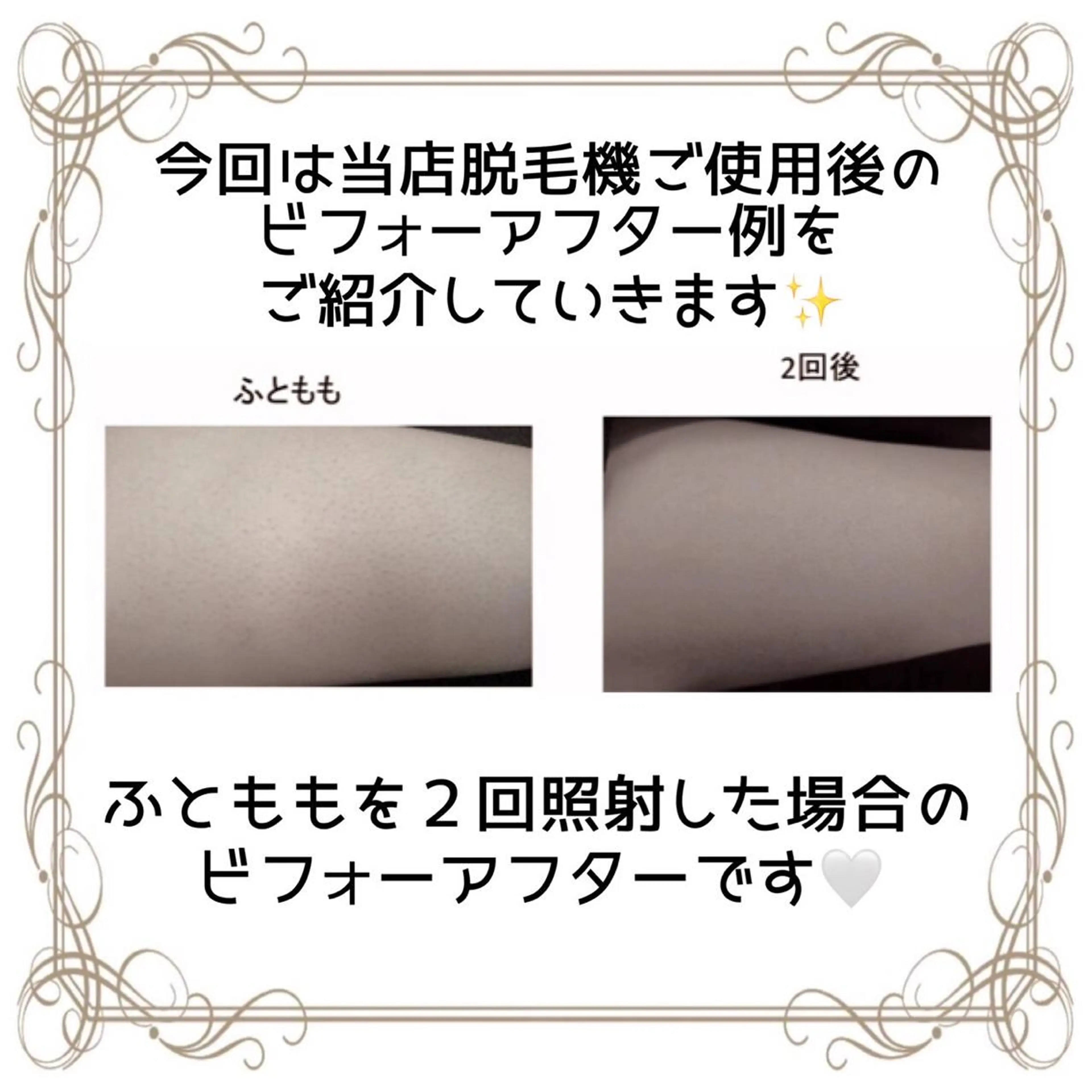 脱毛 セルフエステサロンBATON所属・セルフエステサロン BATONのエステ・リラクイメージ