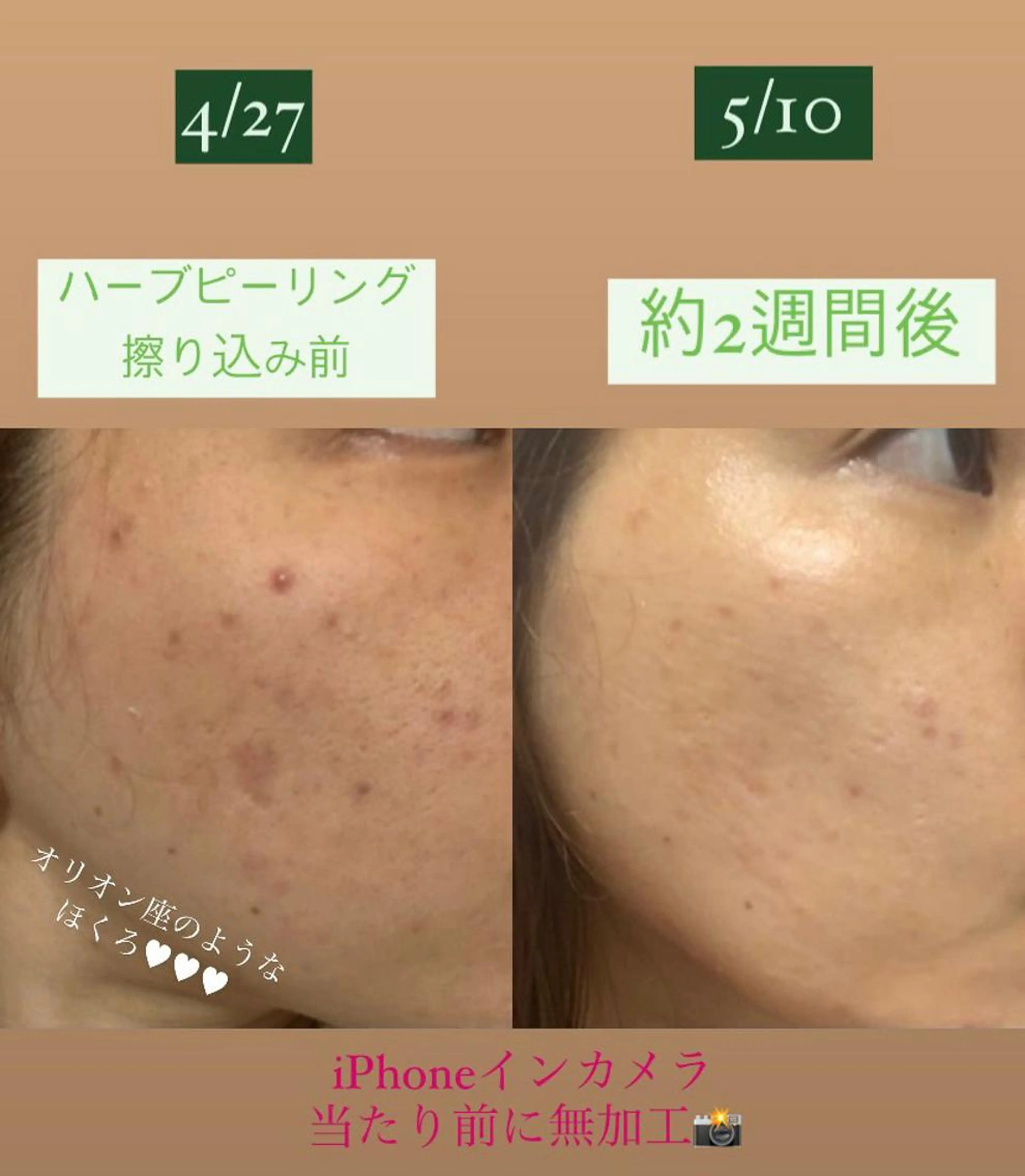 💚ハーブピーリング💚ニキビ・ニキビ跡・アクネ菌・毛穴徹底撃退〜!💥の写真