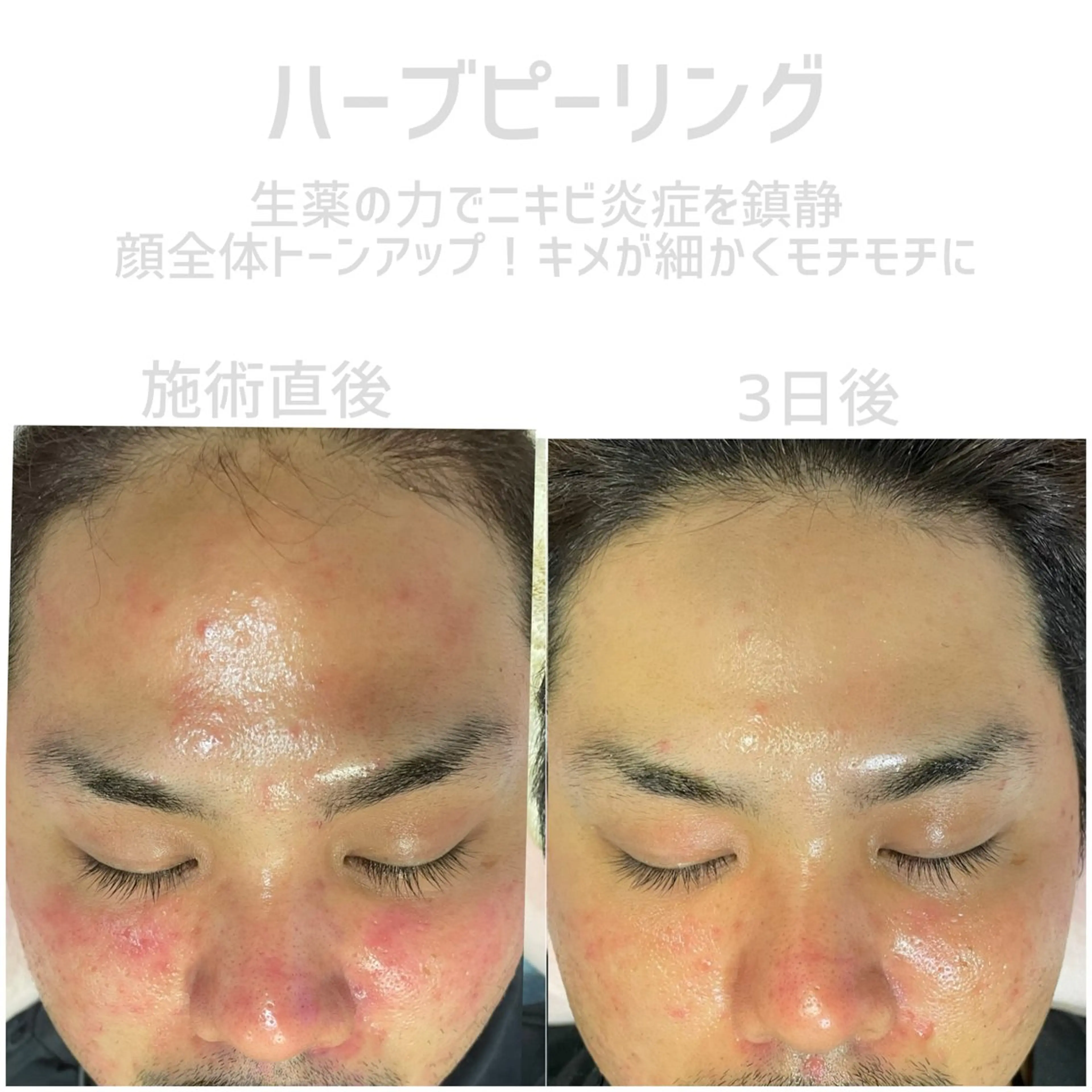 【生薬ハーブピーリング＋ヒト幹細胞パック】剥離なし♡どんなお肌のタイプにもok！アトピーやニキビにも✨美白美肌に♡の写真