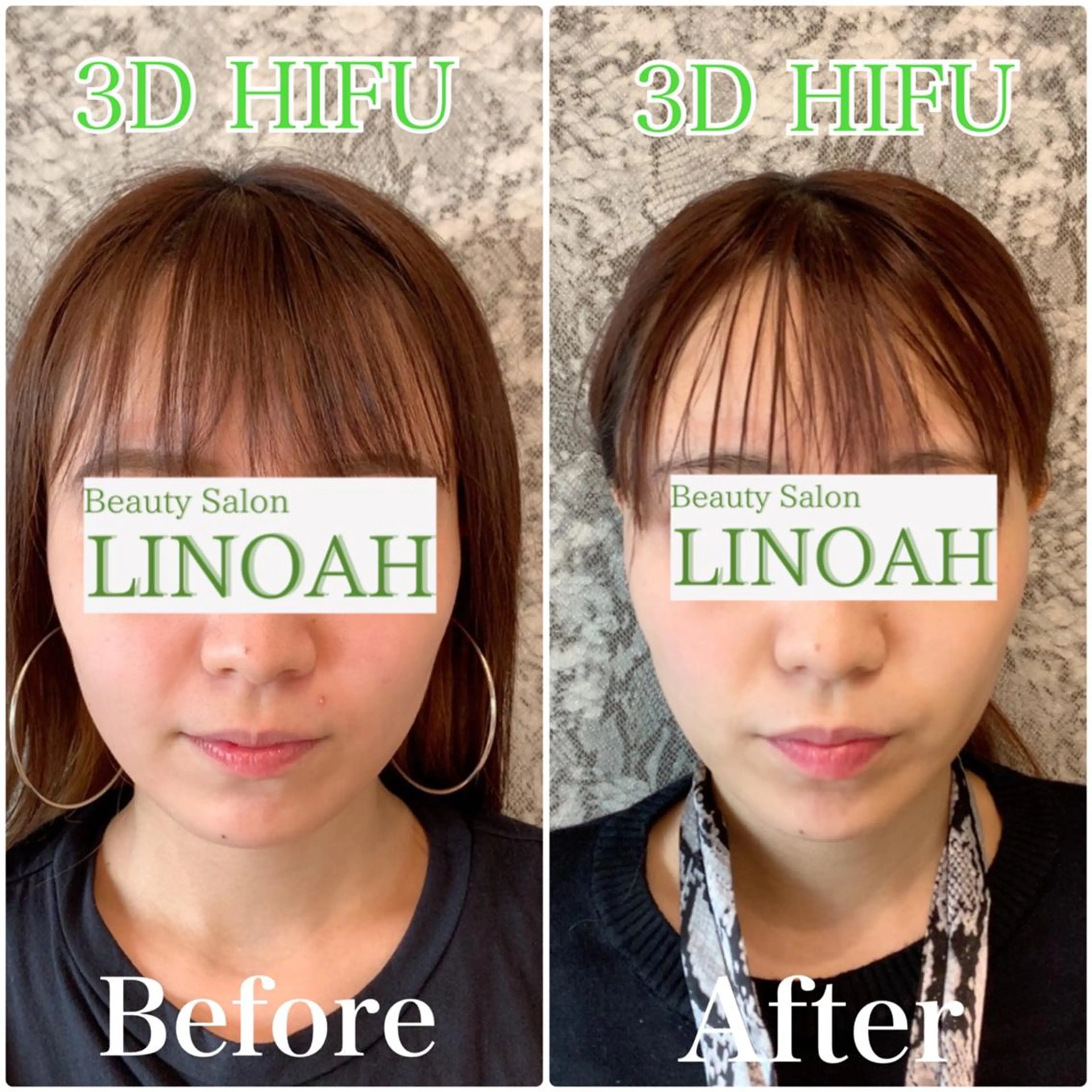 人気No.３【小顔/たるみ改善/リンパ】⭐️メスを使わないウルトラプラス３Dリフトアップ⭐️￥19800⇒¥9800の写真