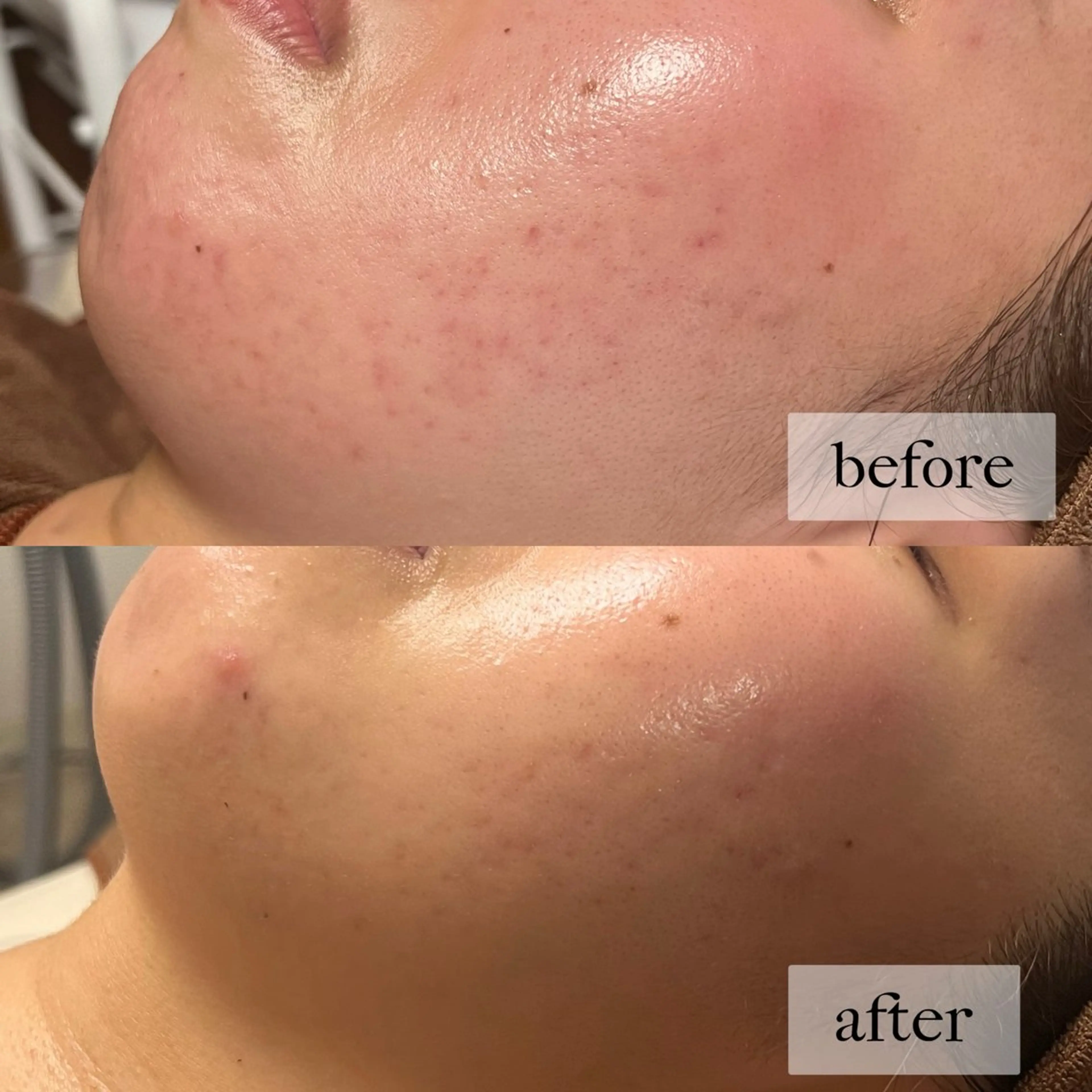 HINANO矢場町店【ヒナノ】所属・脱毛/肌改善🌿 HINANO 村田のエステ・リラクイメージ