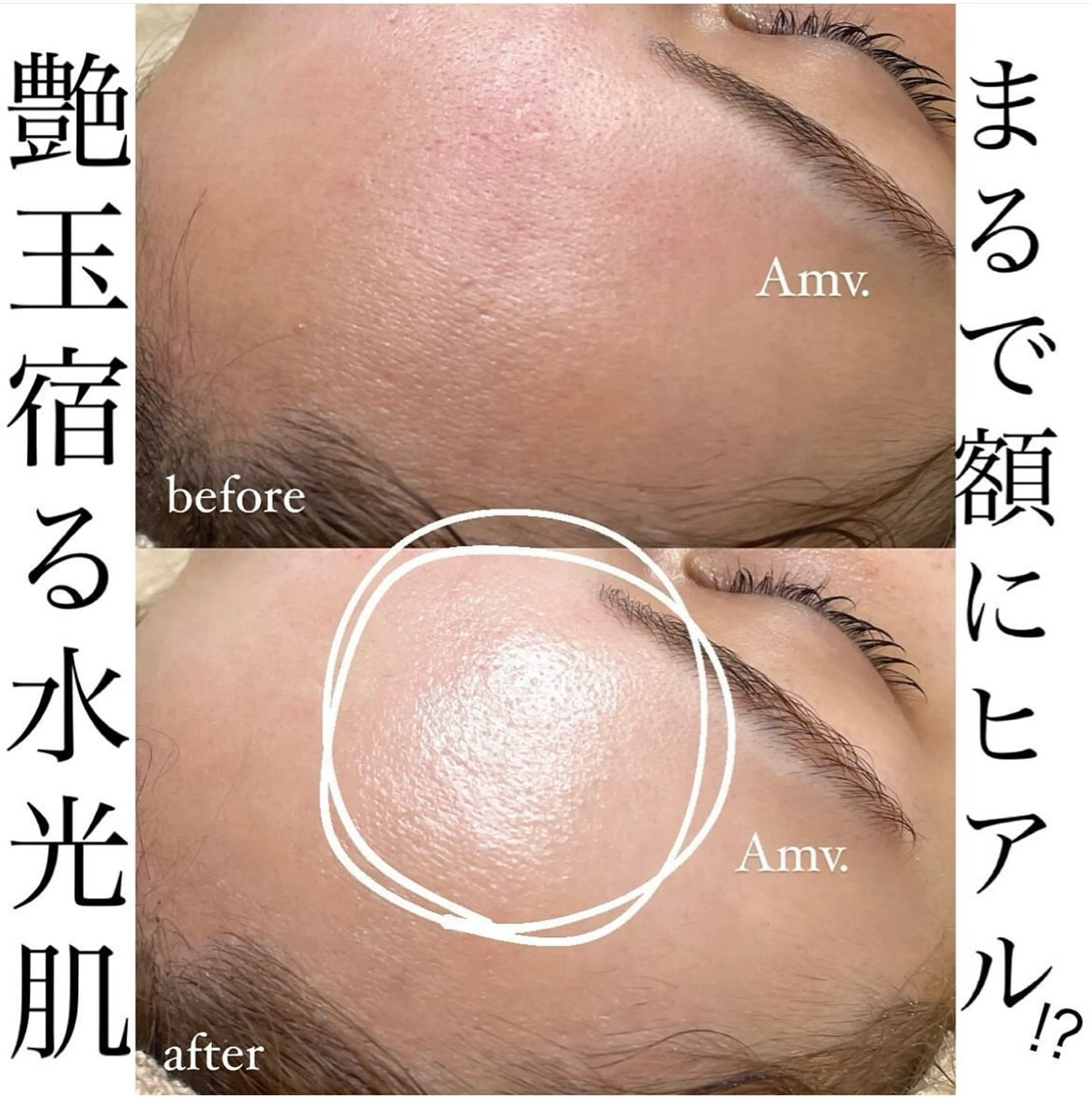 【ウェディング/特別なご予定の前に】REVI角質ケア+エメ水肌ポレ+鎮静パックの写真