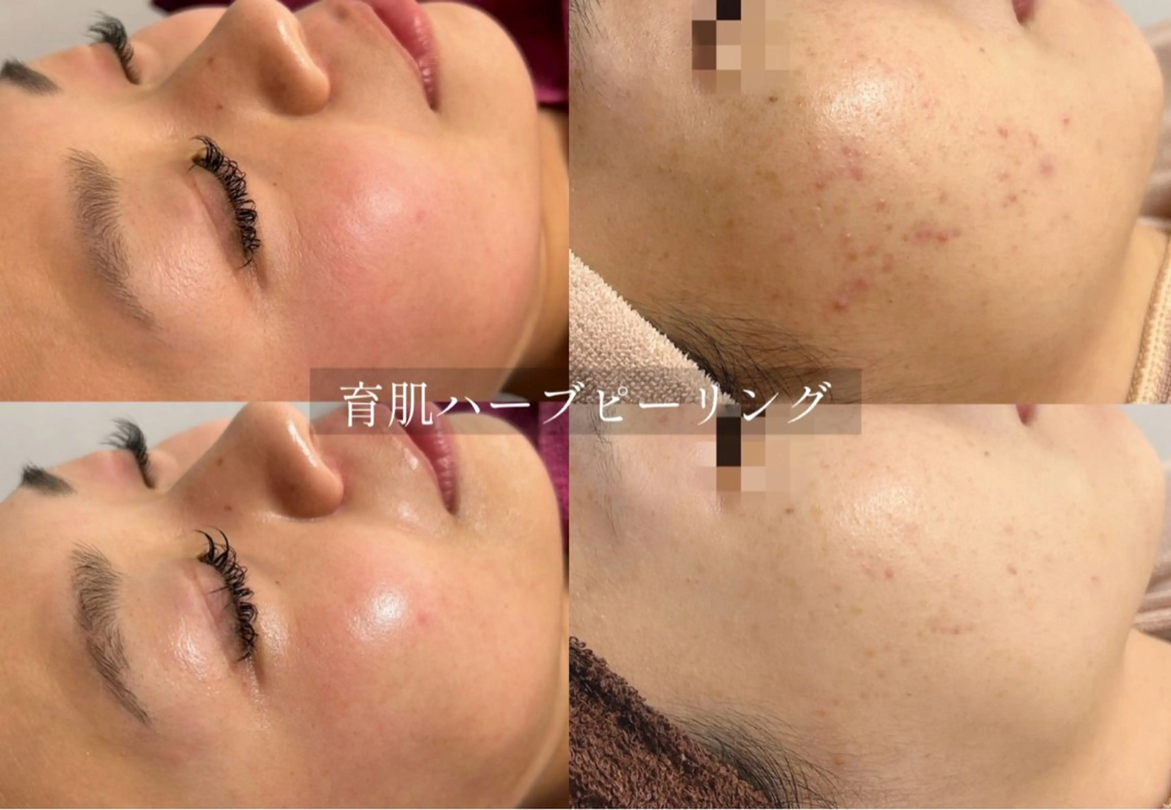 痛み剥離なし☆育肌®︎ハーブピーリング/肌荒れ・乾燥・毛穴・ニキビ・小ジワ・赤み・むくみ等を自らの力で肌質改善!の写真