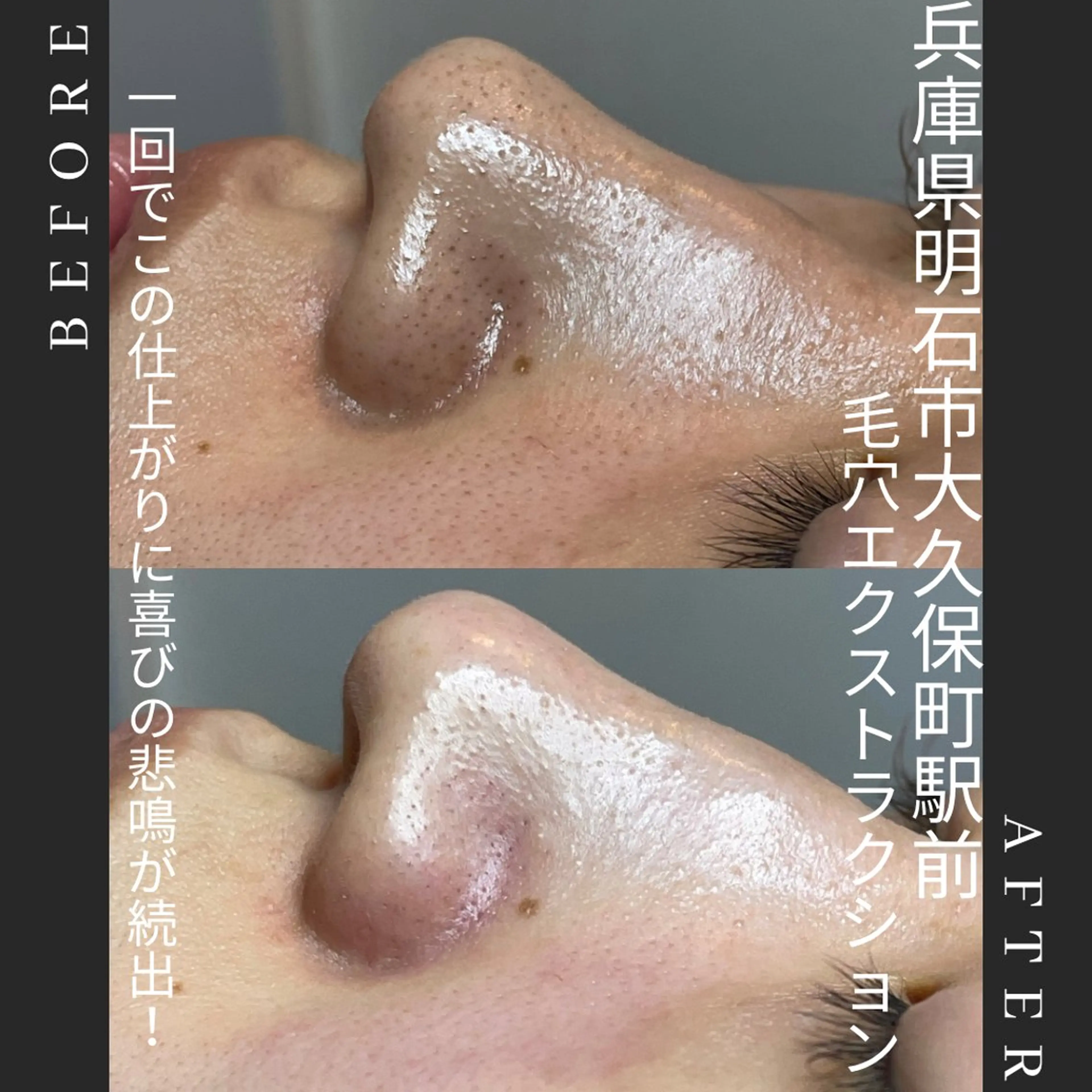 🌱初回限定。毛穴エクストラクション全顔(光フェイシャル付き)メンズも施術可能🉑の写真