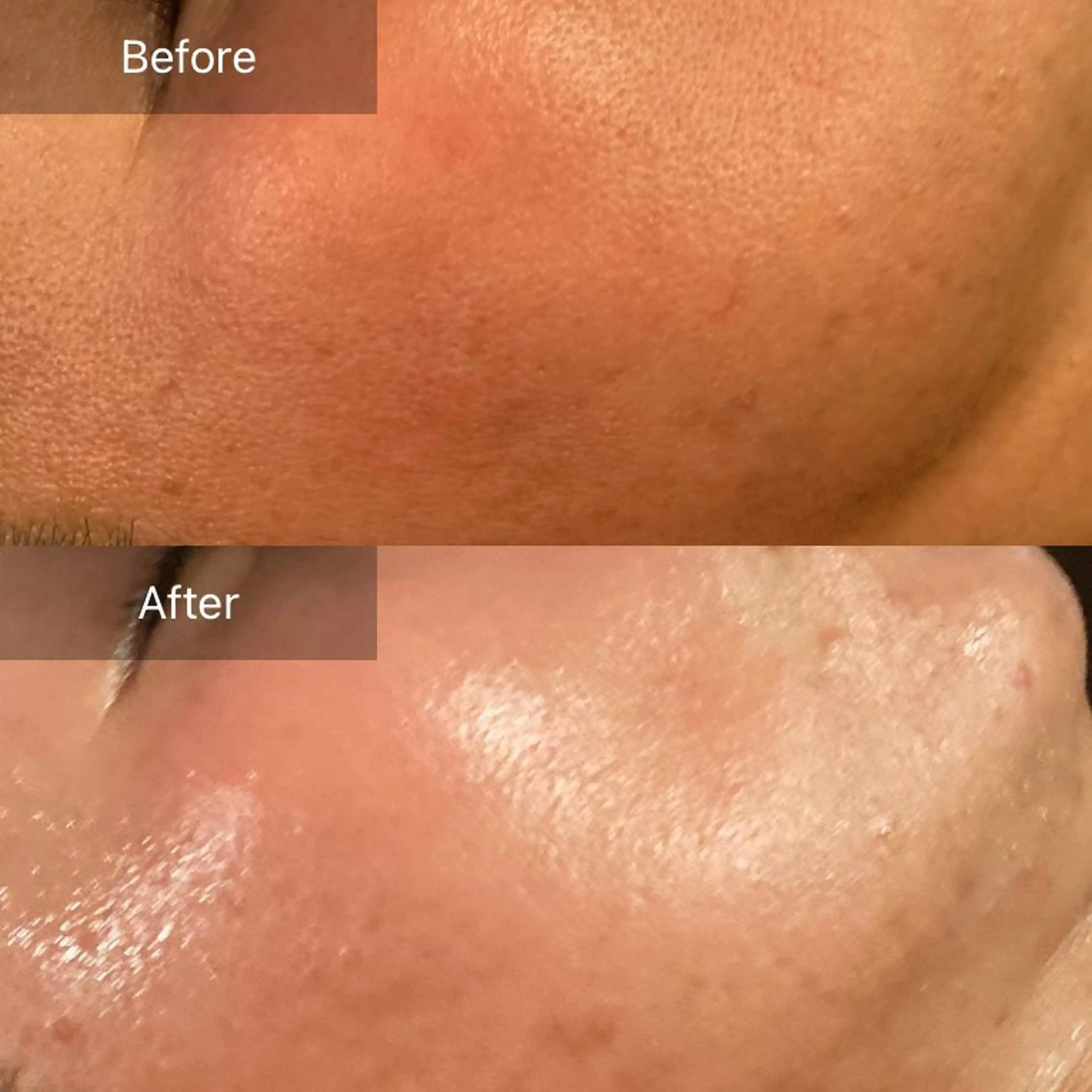 針、メスなし❤️毛穴修復スペシャル⭐️生コラーゲン注入付き【大きい毛穴、たるみ凸凹毛穴ケア】お茶カウンセリング込120分の写真